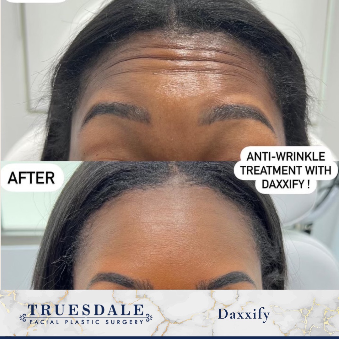 Botox and Jeuveau before and after — forehead lines smoothed · before and after composite