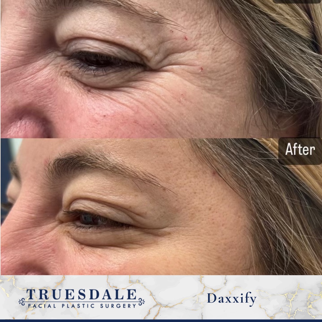 Botox and Jeuveau before and after — crow's-feet and periorbital lines softened · before and after composite