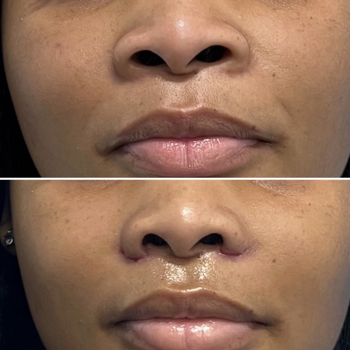 Alarplasty before and after &mdash; nostril refinement · before and after composite