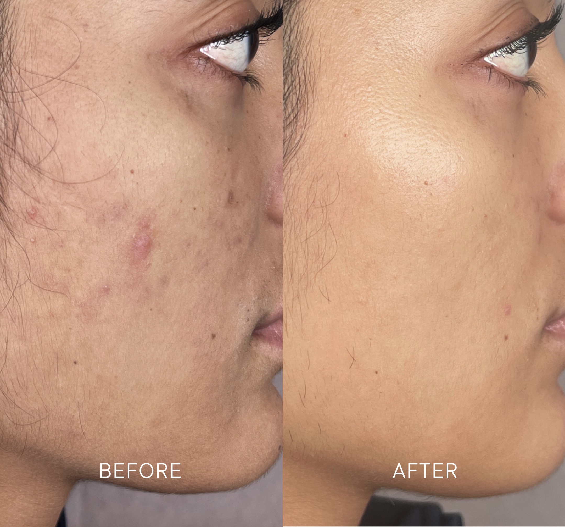Artisa skincare before and after · before and after composite