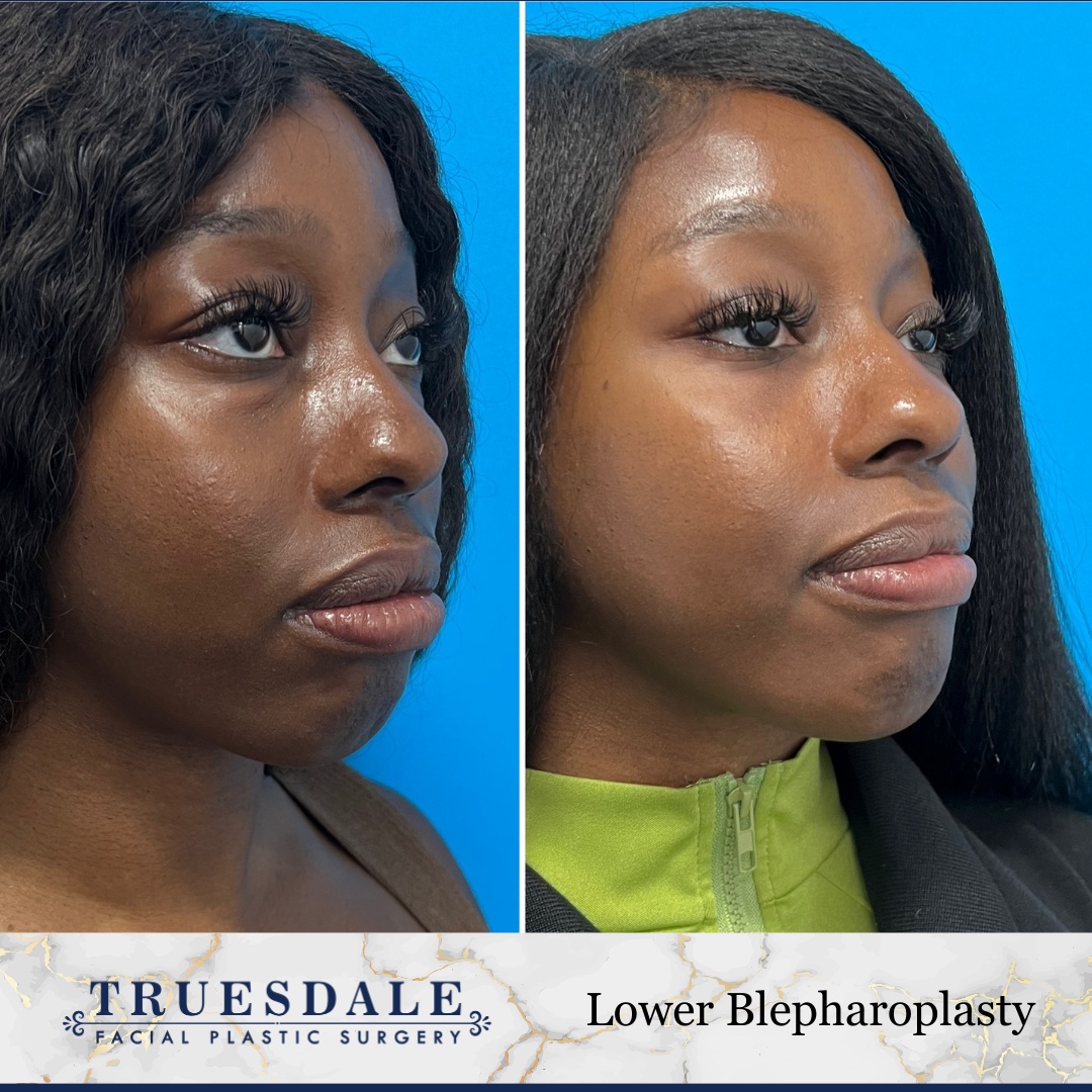 Before and after — lower blepharoplasty, oblique view