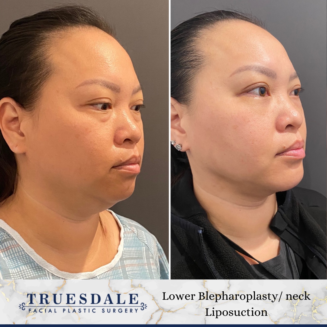 Before and after — lower blepharoplasty and neck liposuction, oblique view