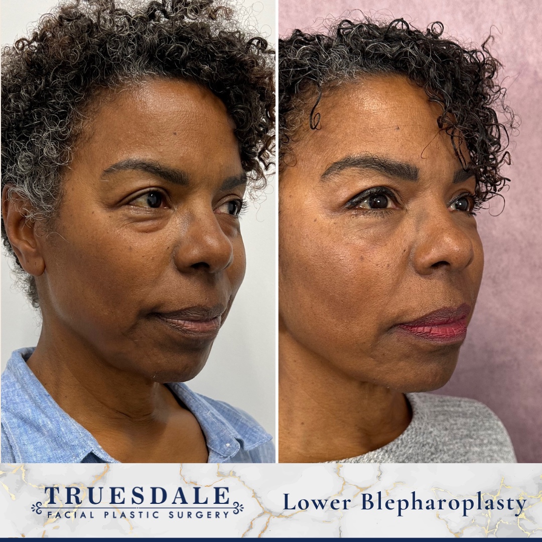 Before and after — lower blepharoplasty, oblique view