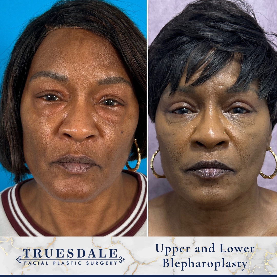Before and after — upper and lower blepharoplasty, frontal view