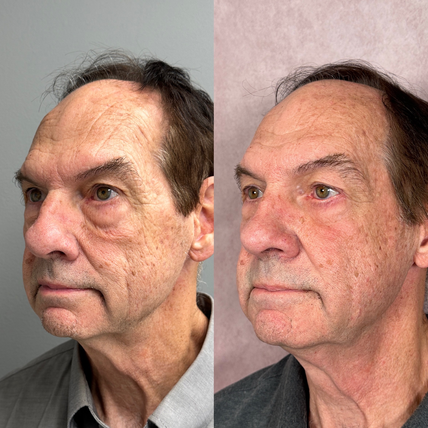 Before and after &mdash; male lower blepharoplasty, oblique view