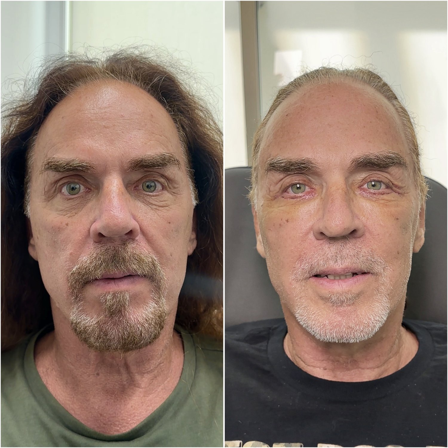 Lower blepharoplasty + fat transfer before and after · frontal view