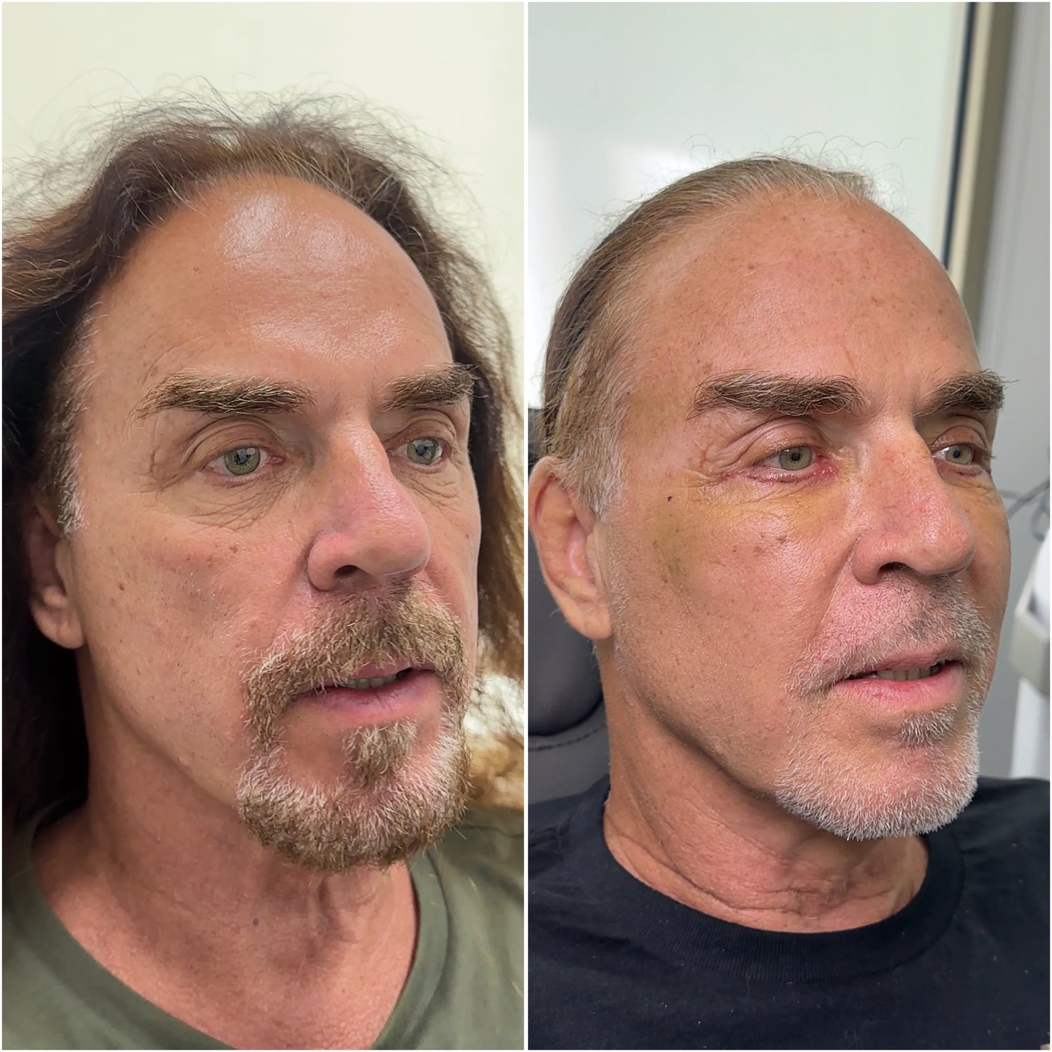 Before and after &mdash; male lower blepharoplasty with fat transfer, oblique view