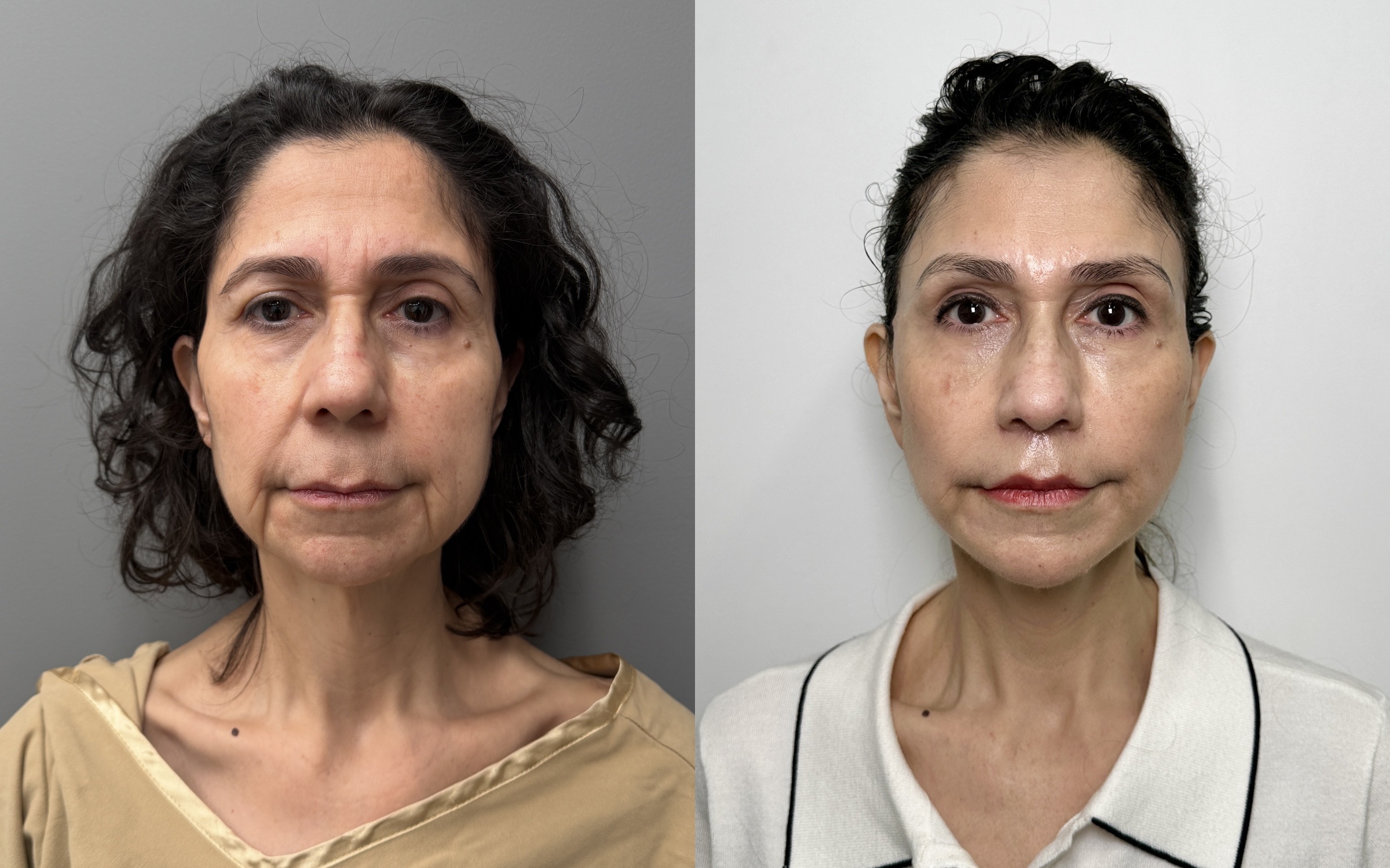 Brow Lift + Facelift + Neck Lift + Lower Bleph before and after · before and after composite