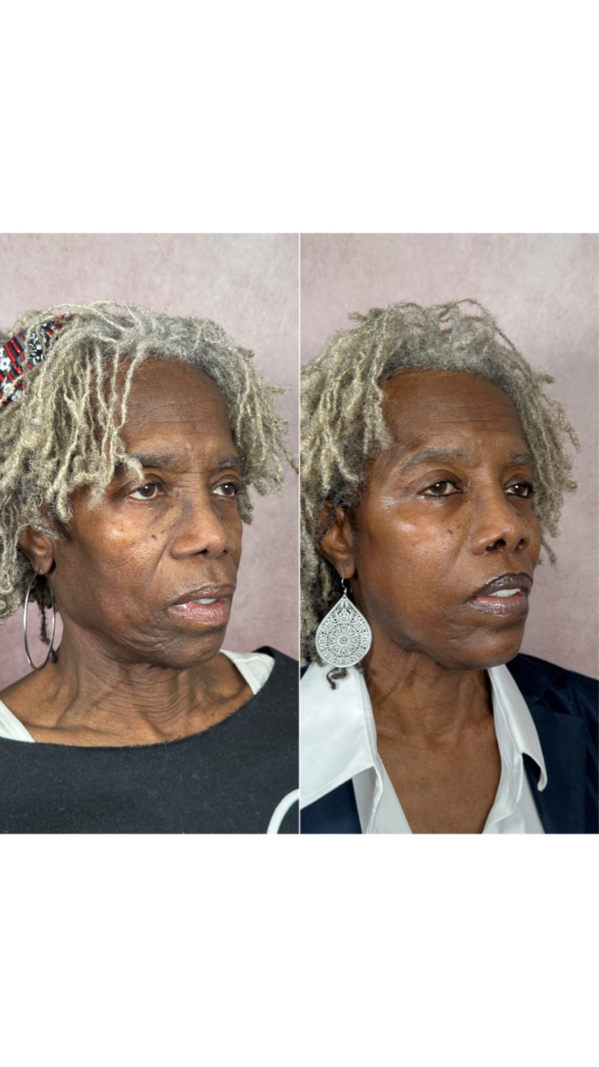 Before and after &mdash; brow lift as part of The Masterpiece, oblique view