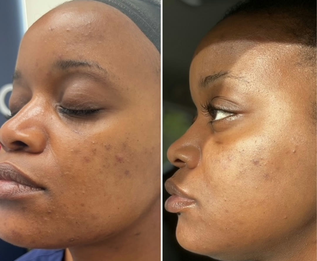 Chemical peel before and after &mdash; acne scarring and hyperpigmentation correction on melanin-rich skin · before and after composite