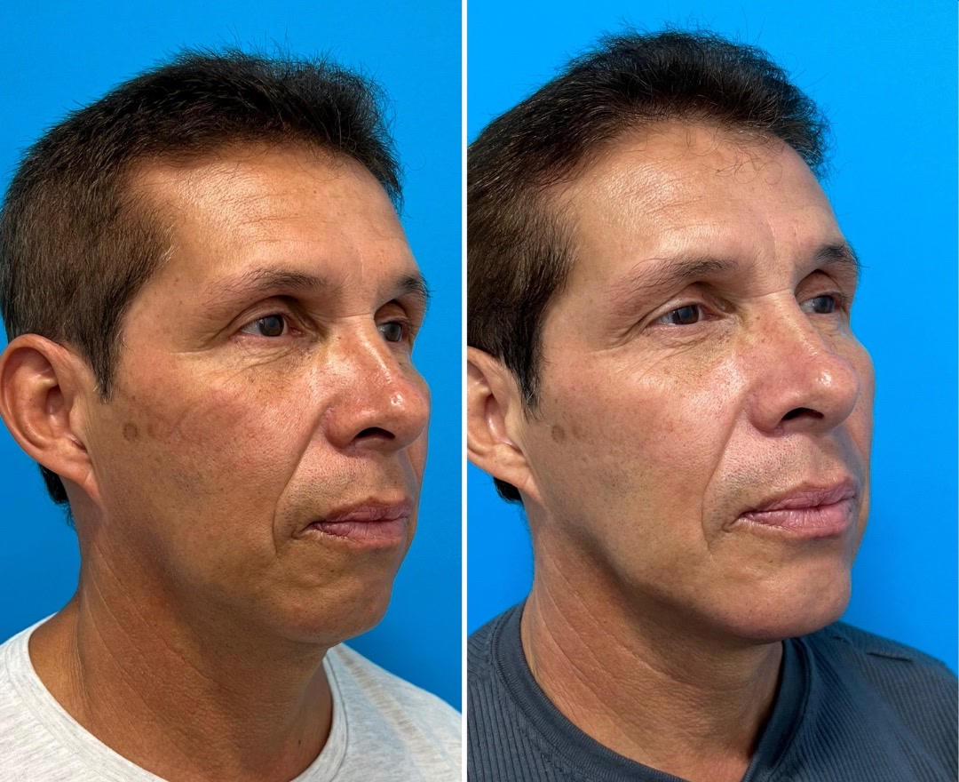 Chin implant before and after, oblique view