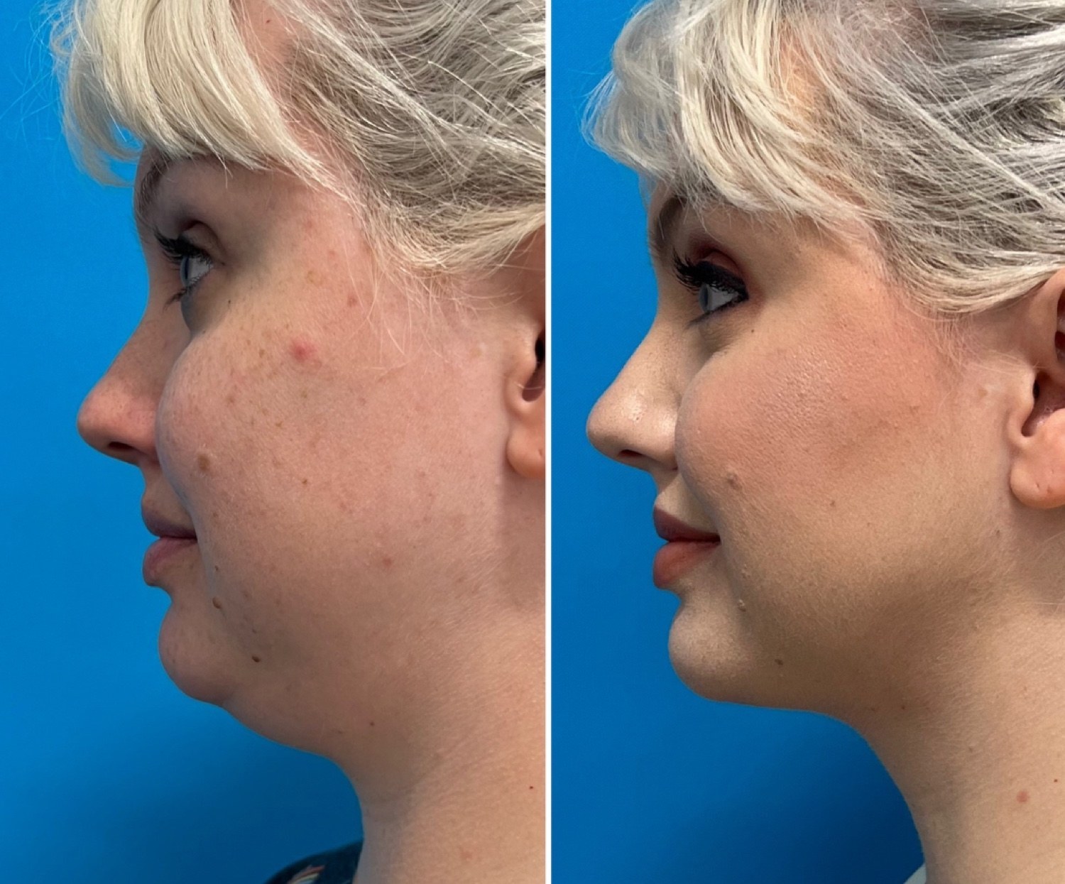 Before and after &mdash; neck liposuction and FaceTite · before and after composite