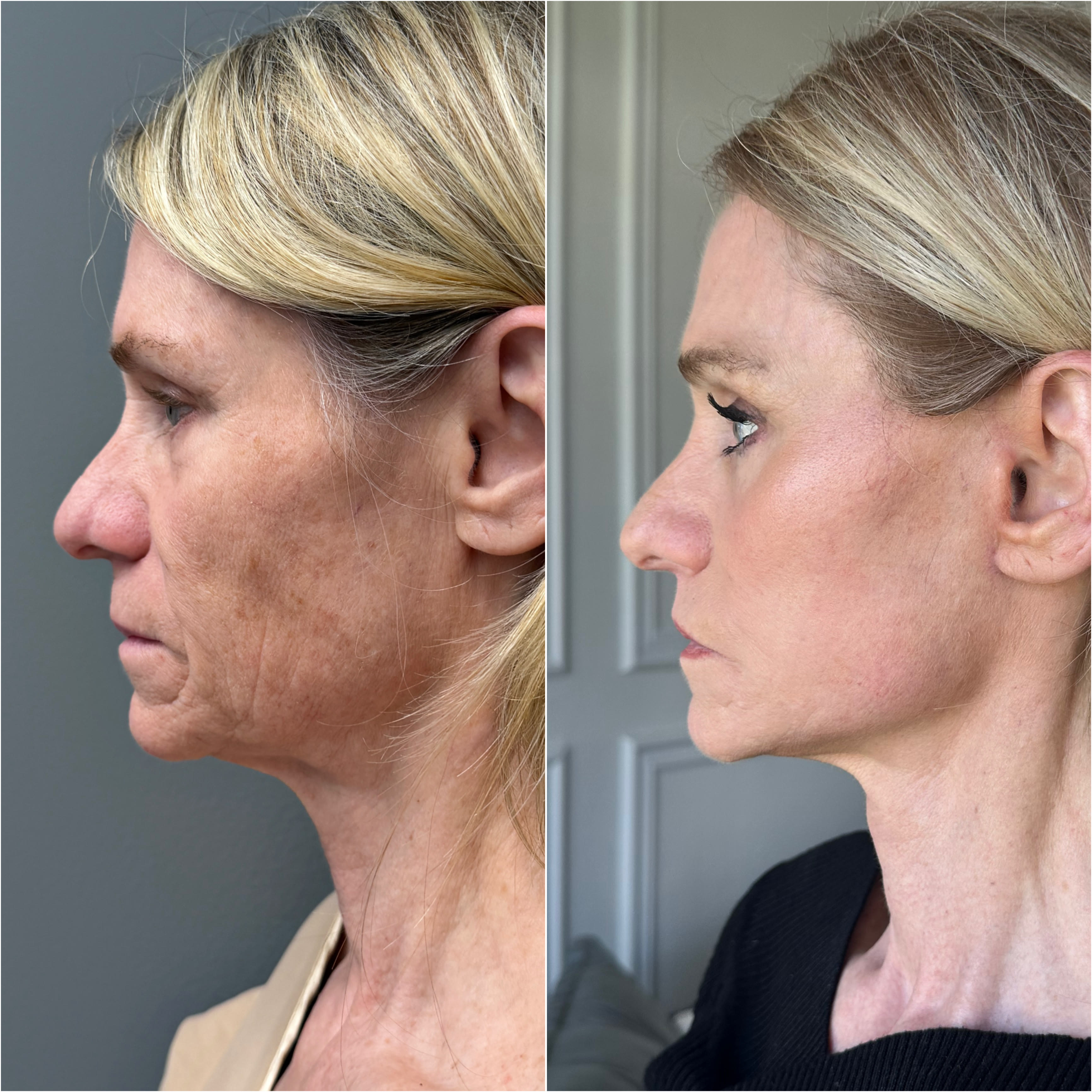 CO2 laser combined with surgical procedures before and after · before and after composite
