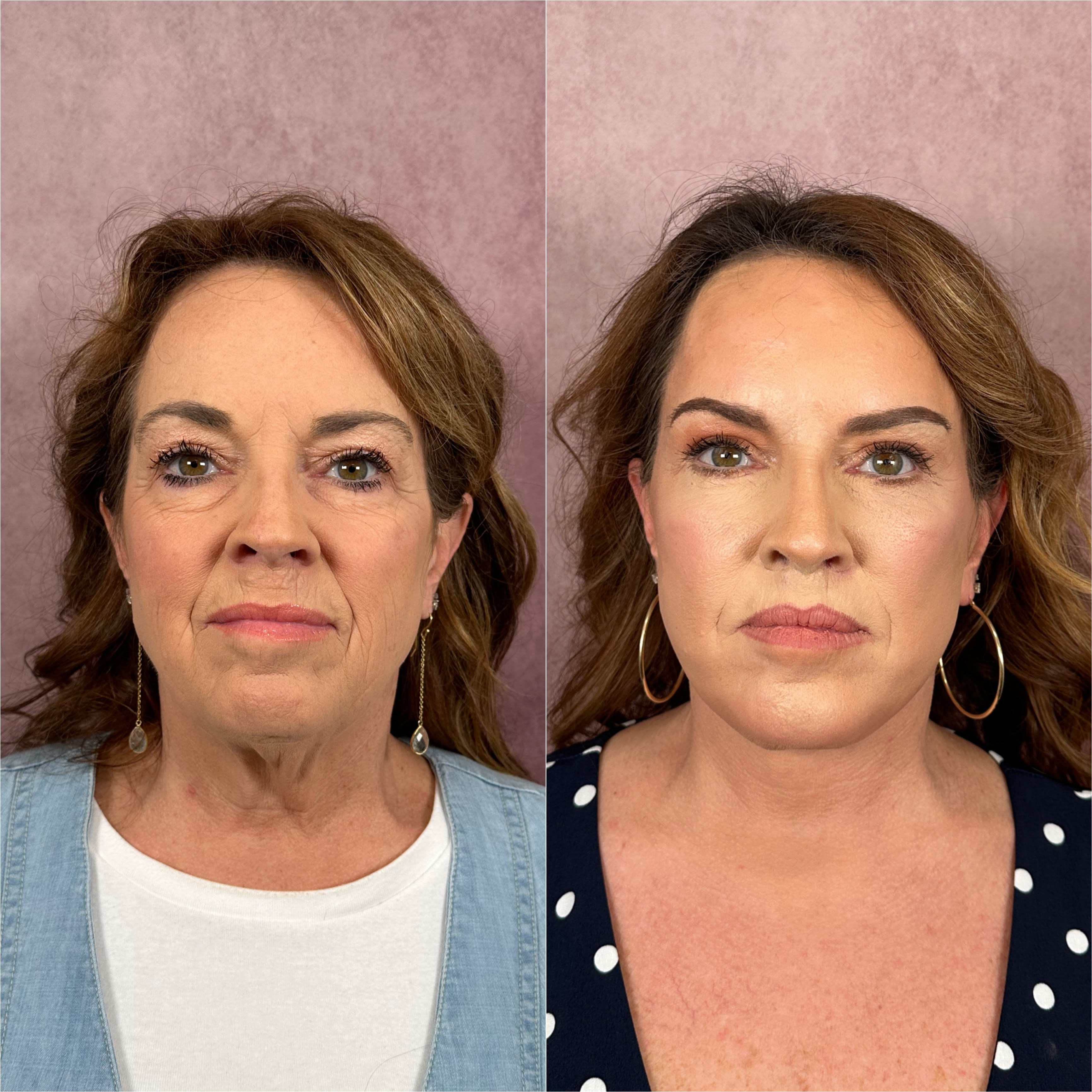 CO2 laser combined with surgical procedures before and after · before and after composite