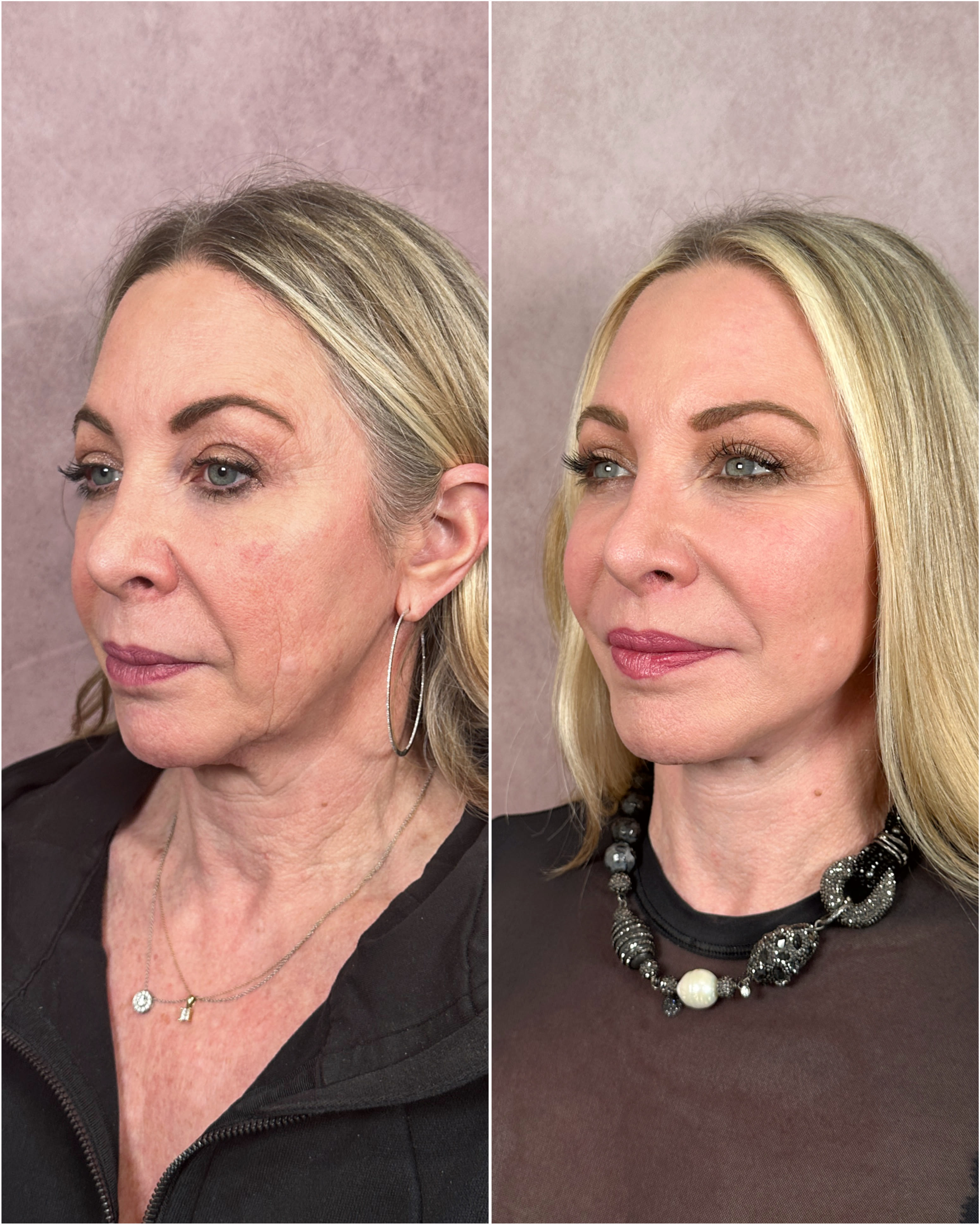 CO2 laser combined with surgical procedures before and after · before and after composite
