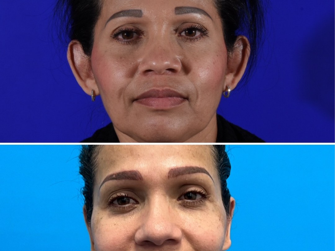 Ear surgery before and after &mdash; featured patient · frontal view