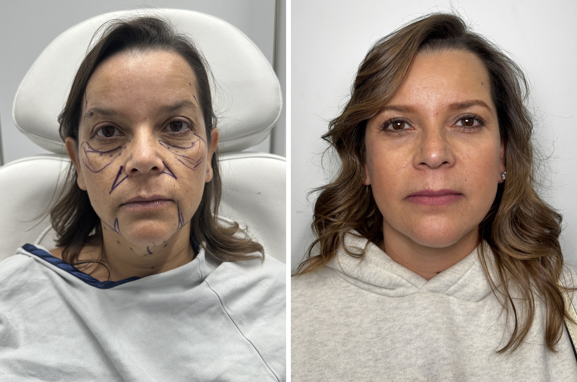 Deep Plane Facelift, Neck Lift & Fat Transfer before and after · before and after composite