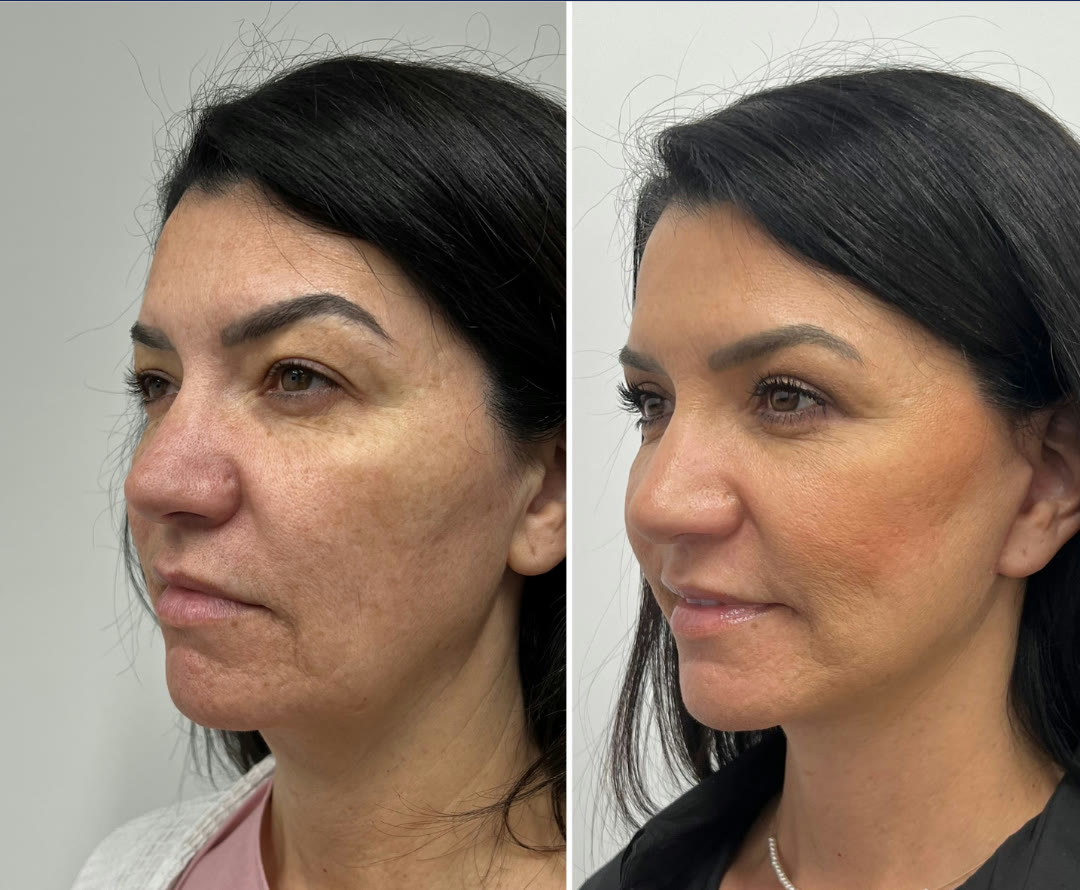 Deep Plane Facelift + Neck Lift + Fat Transfer + Upper Blepharoplasty before and after, frontal view