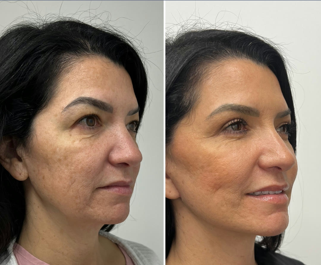 Before and after &mdash; deep plane facelift, neck lift, fat transfer to face, and upper blepharoplasty, oblique view