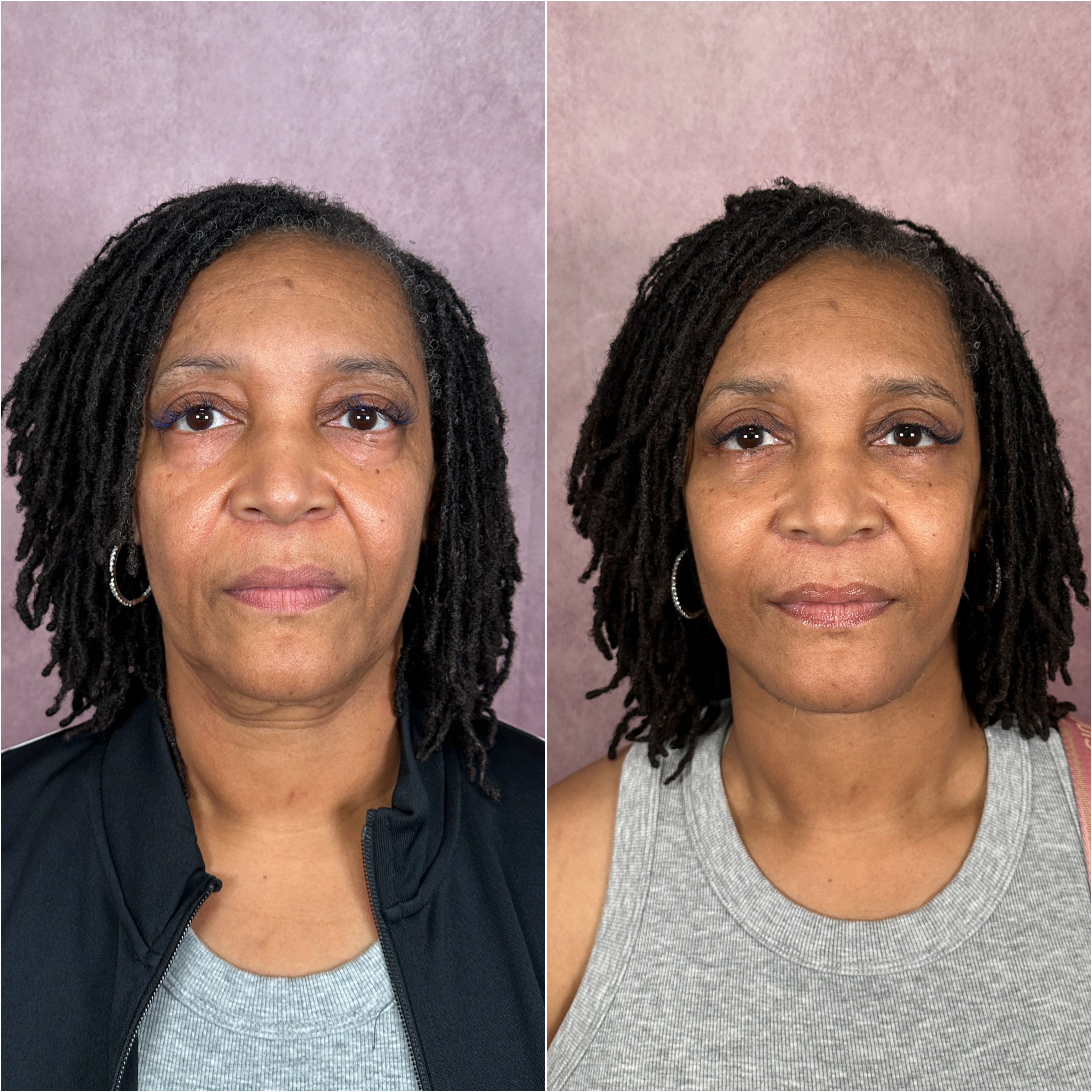 Before and after &mdash; The Masterpiece Surgery&trade;, frontal view