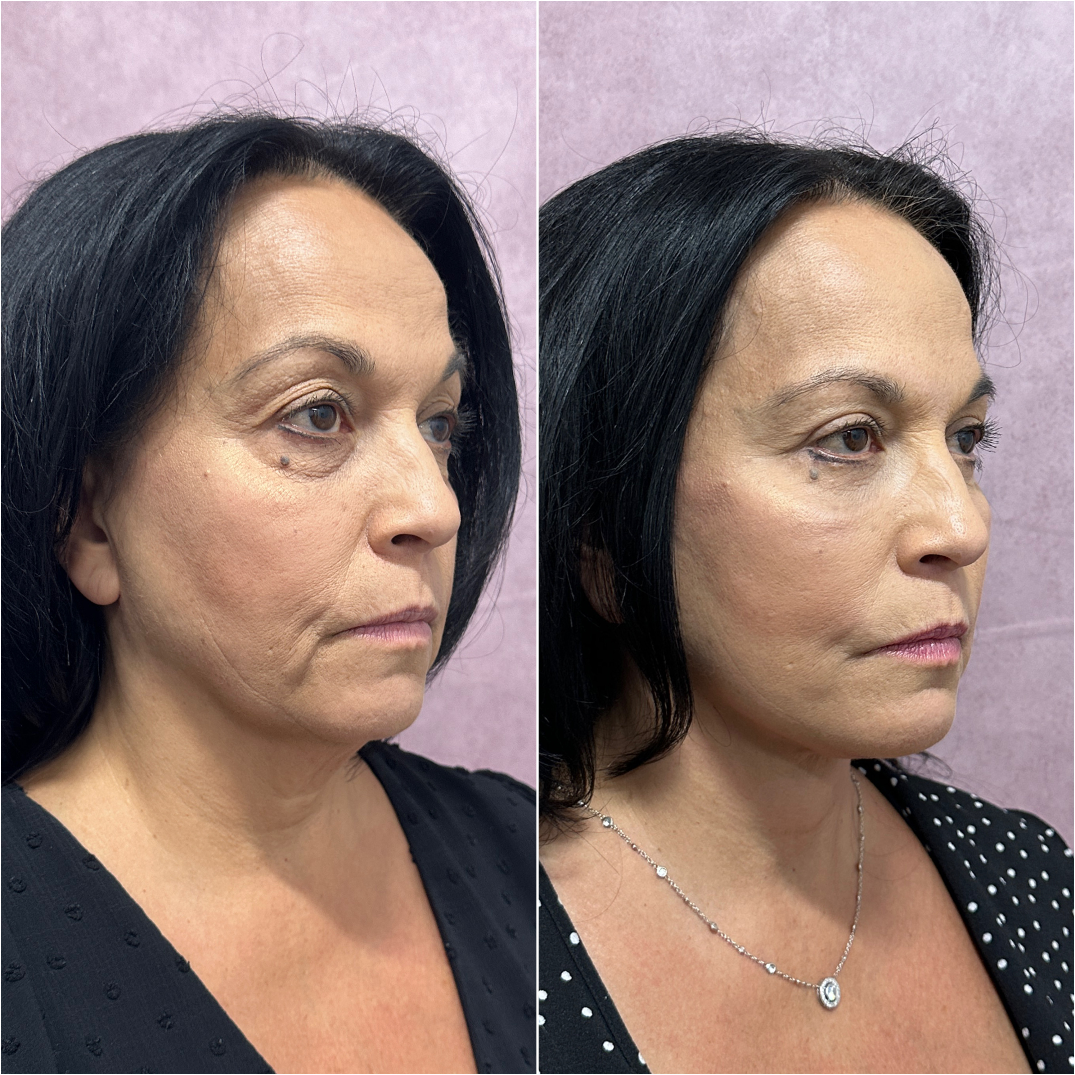 Before and after — lower blepharoplasty as part of The Masterpiece Surgery&trade; · oblique view