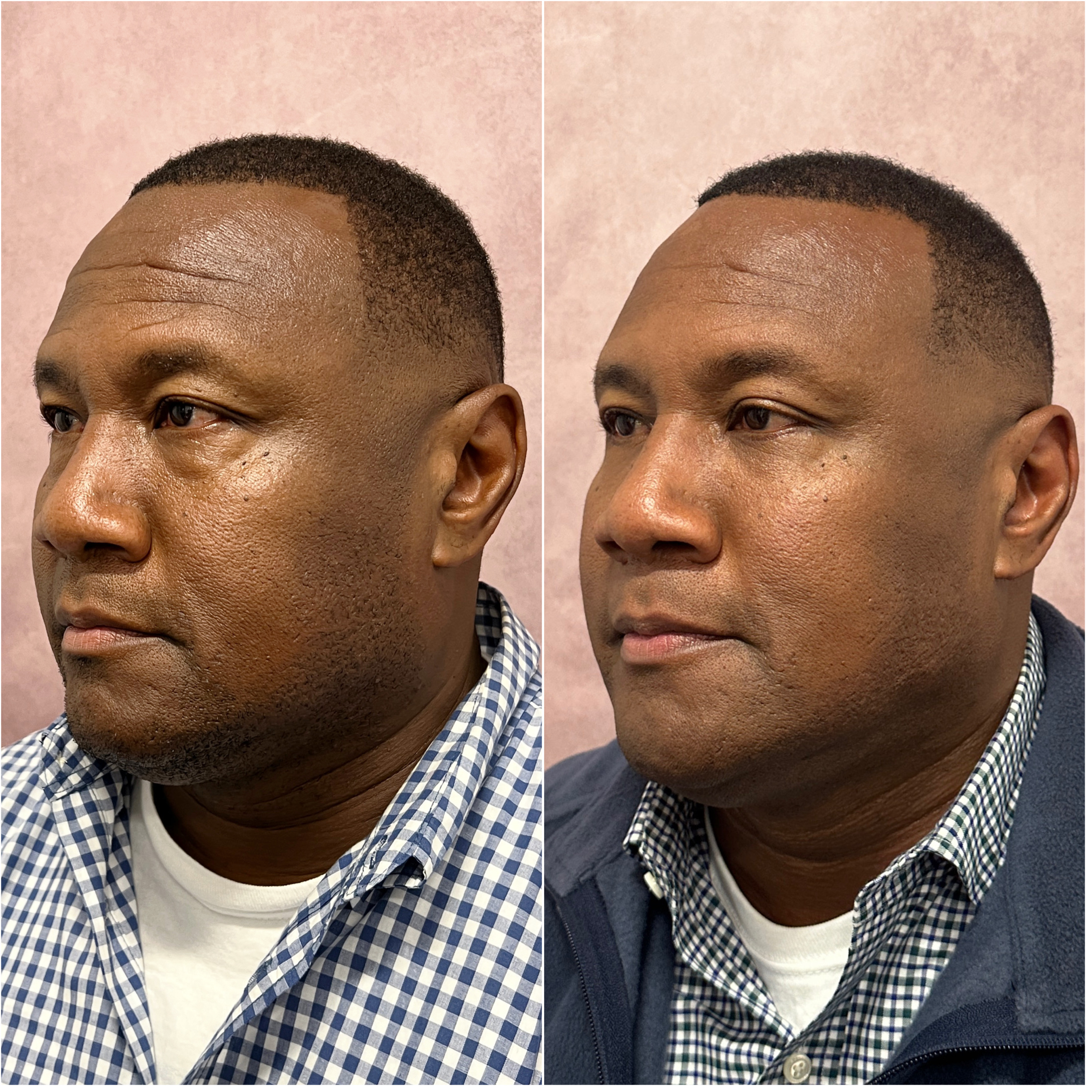 Before and after — male blepharoplasty and brow lift · oblique view