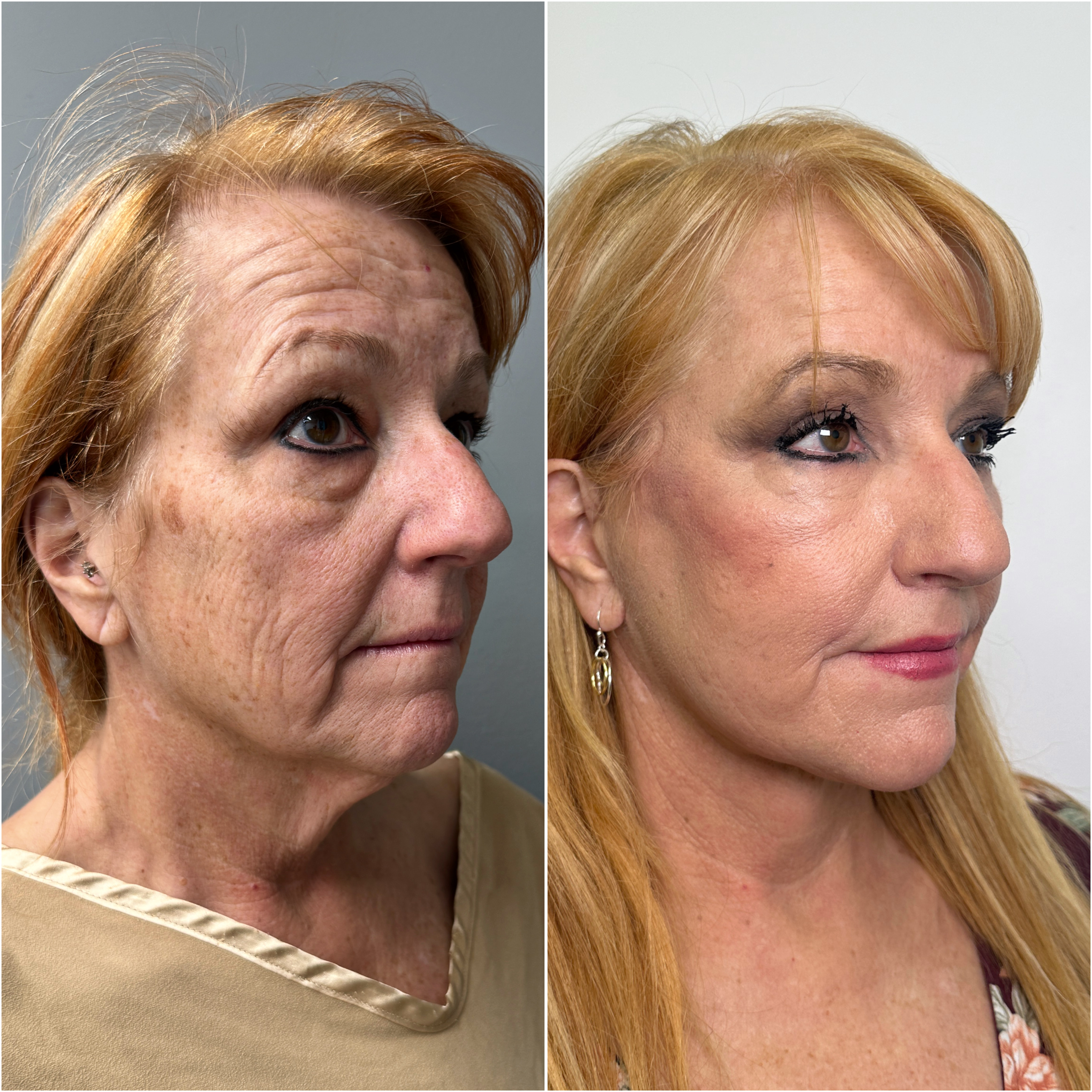 Before and after — deep plane facelift · oblique view