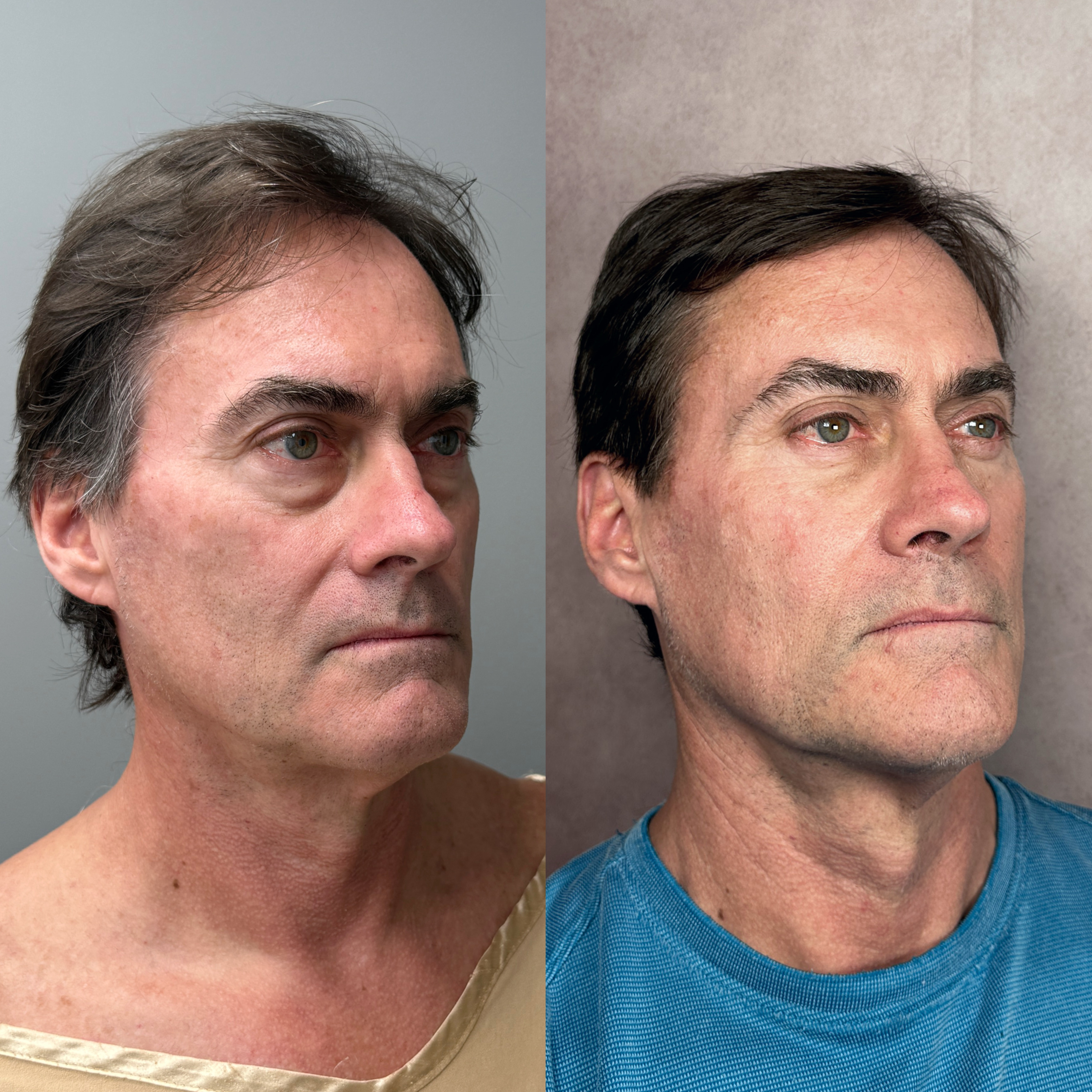 Before and after — male lower blepharoplasty · oblique view
