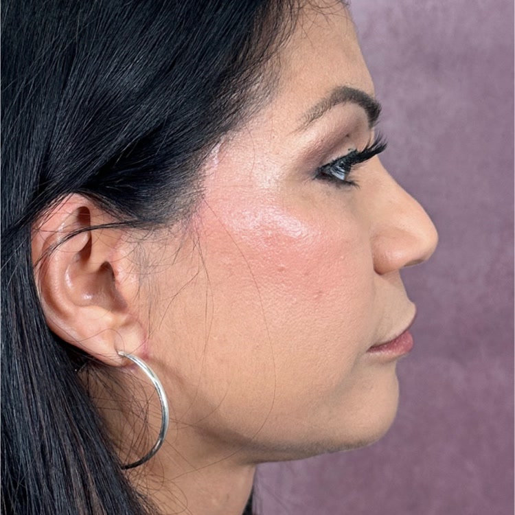 Featured patient Claudia Padilla before and after - Face and Neck Lift · before and after composite