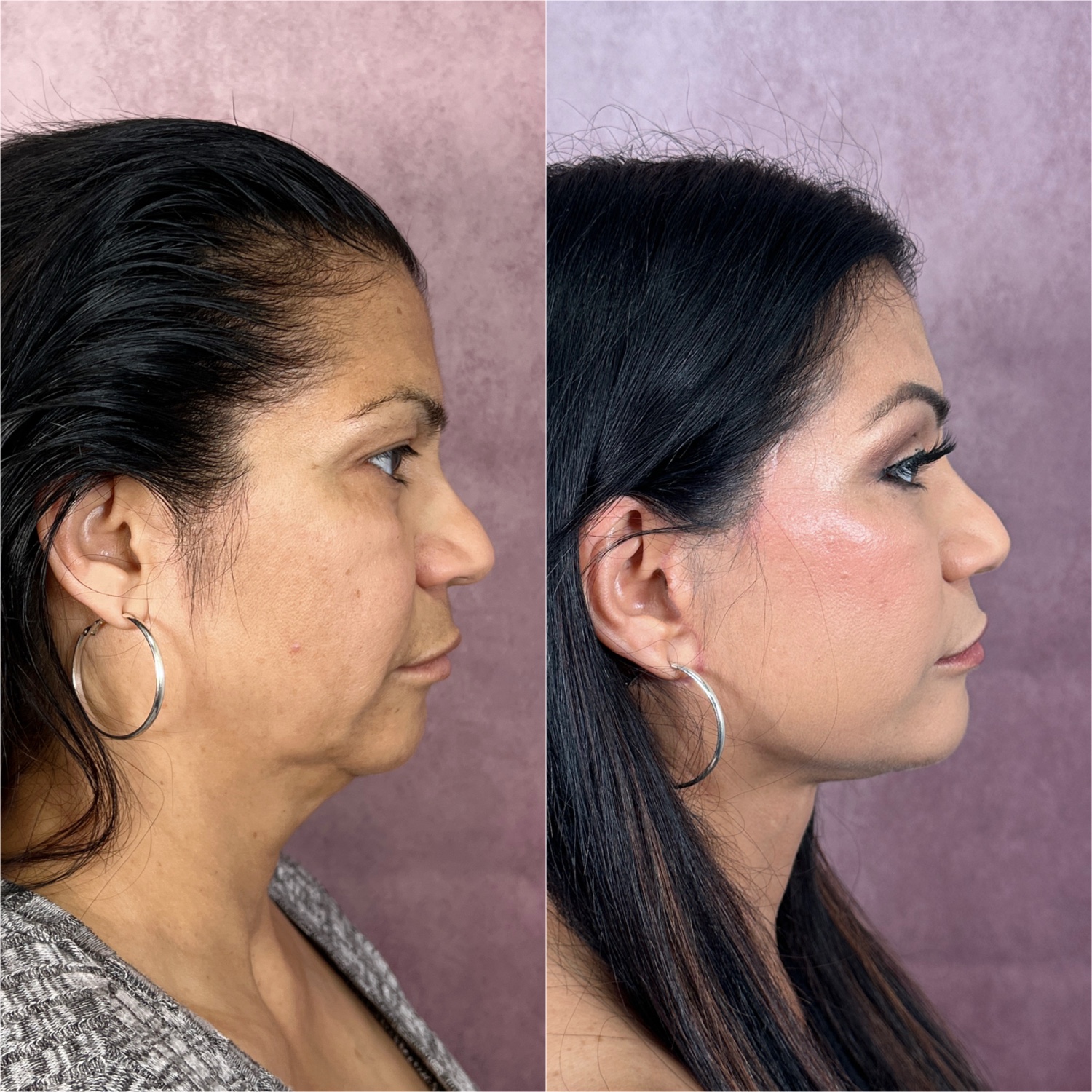Facelift + Other Procedures before and after · frontal view