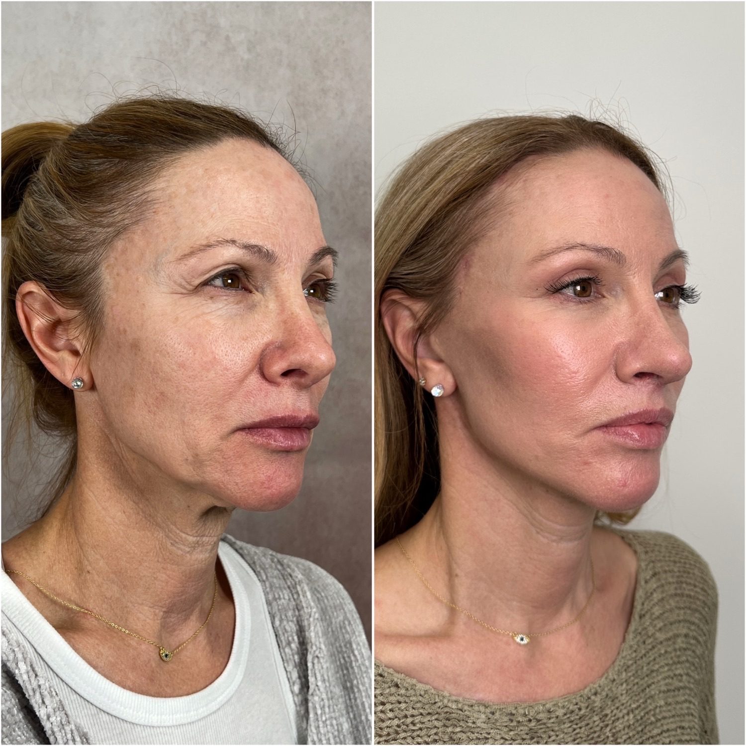 Before and after &mdash; deep plane facelift and neck lift, oblique view