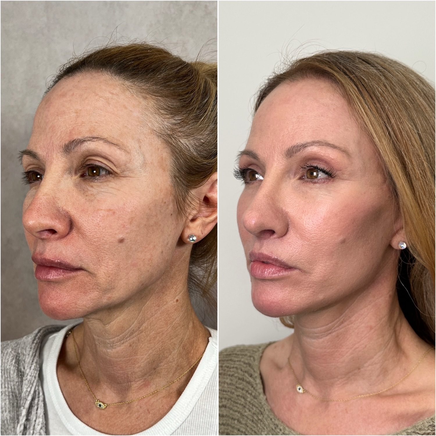 Before and after &mdash; deep plane facelift and neck lift, opposite oblique view