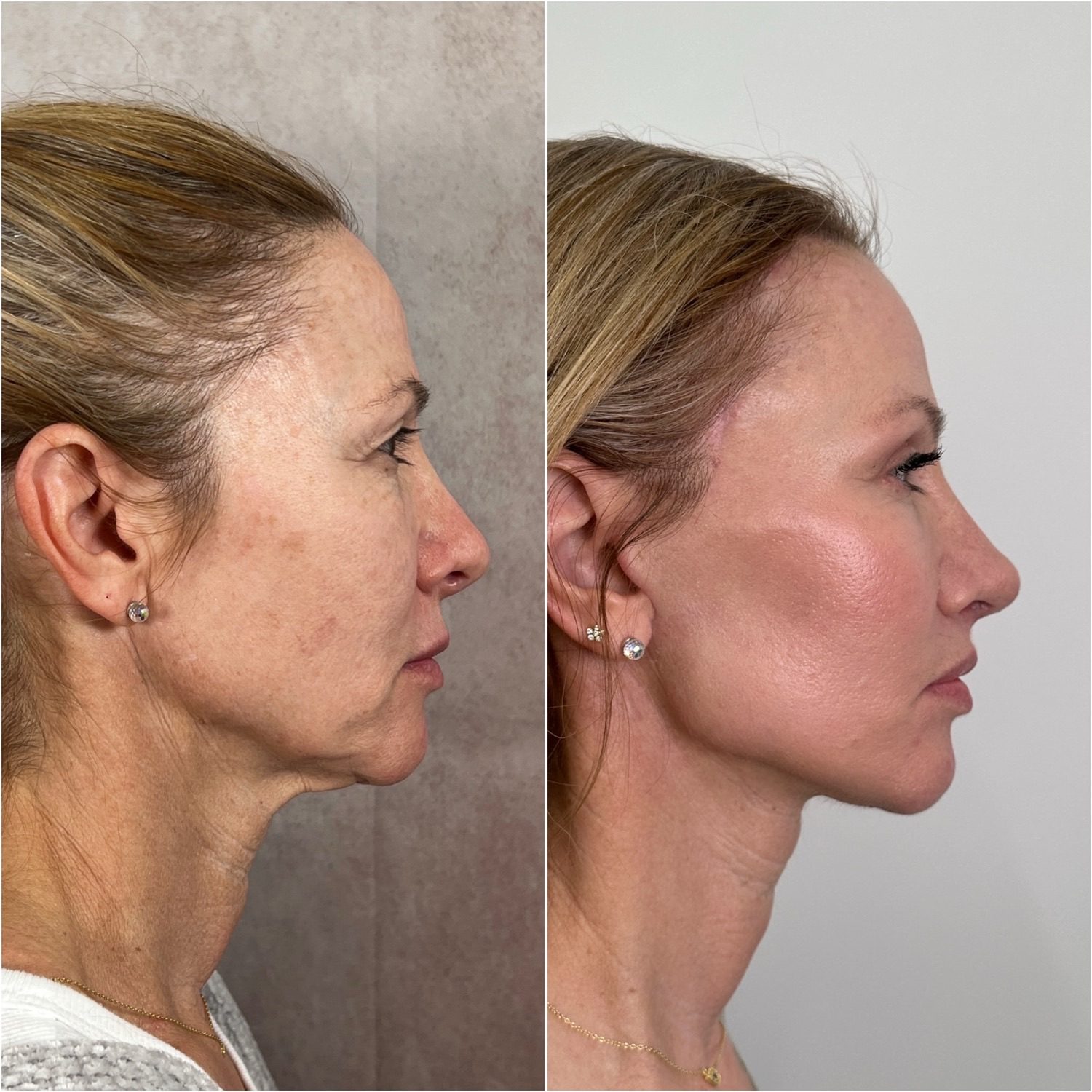 Before and after &mdash; deep plane facelift and neck lift, profile view