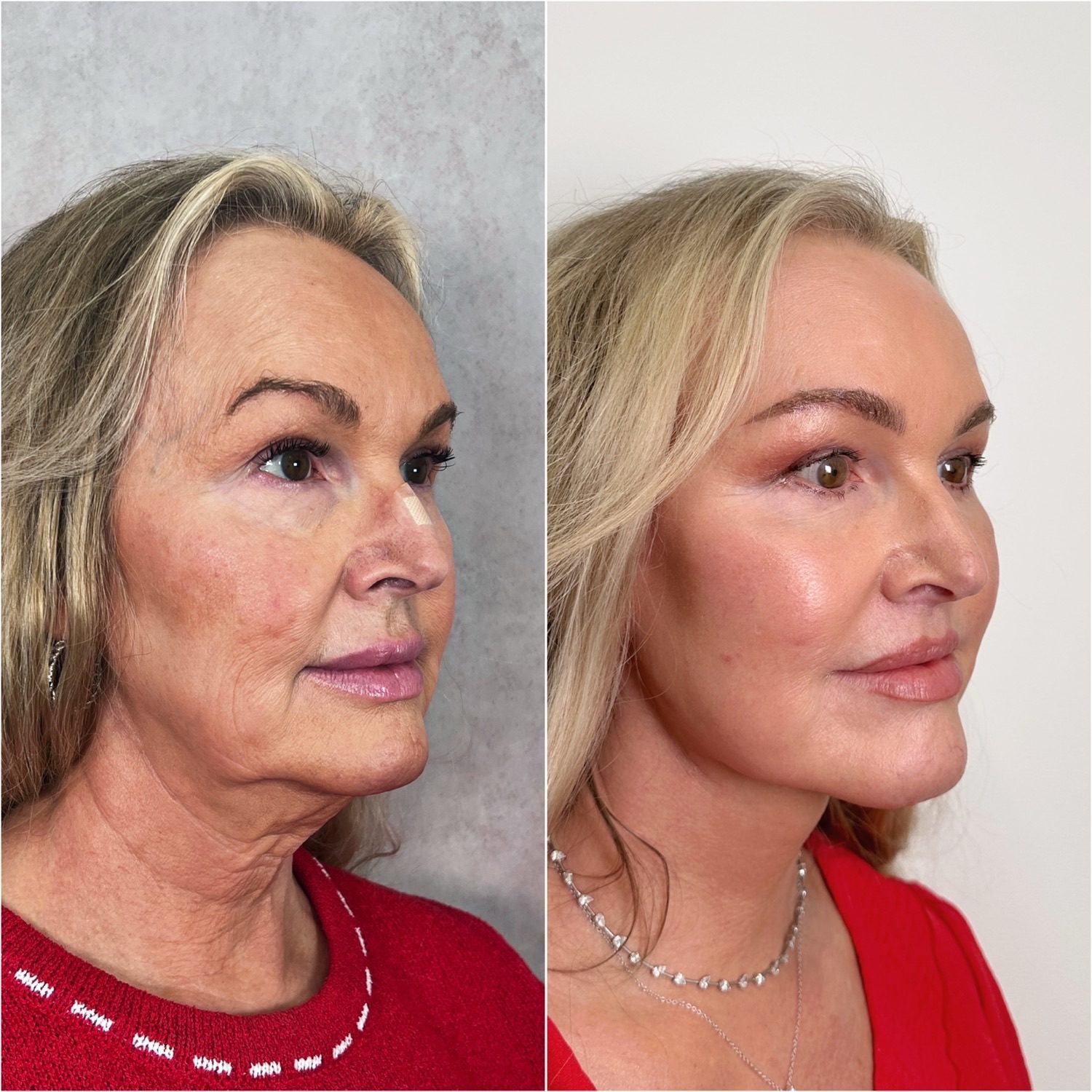 Before and after &mdash; facelift and neck lift as part of The Masterpiece Surgery&trade; with brow lift, upper blepharoplasty, lower lid skin pinch, lip lift, fat transfer and CO2 laser resurfacing, oblique view