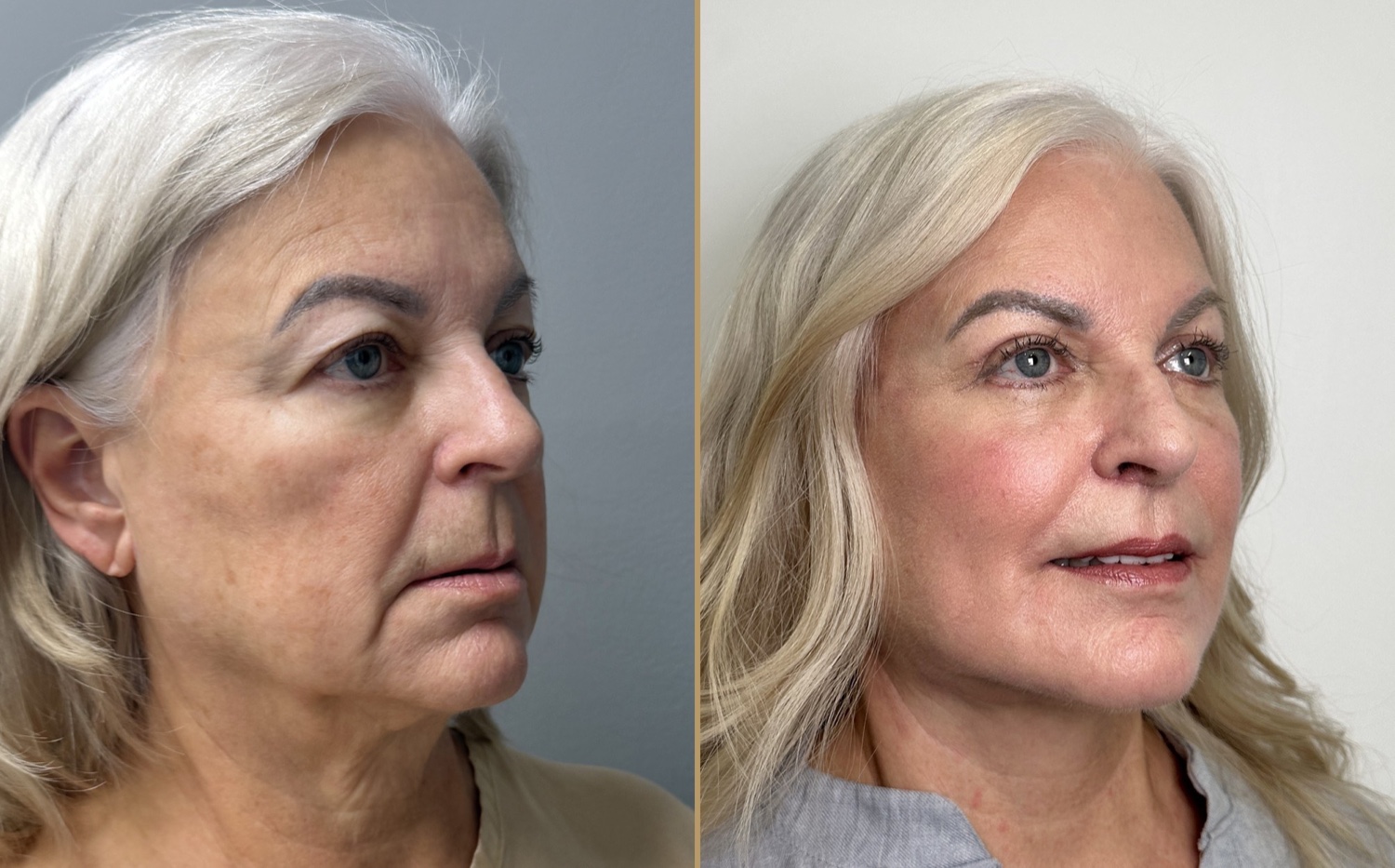 Before and after &mdash; lip lift as part of The Masterpiece, oblique view