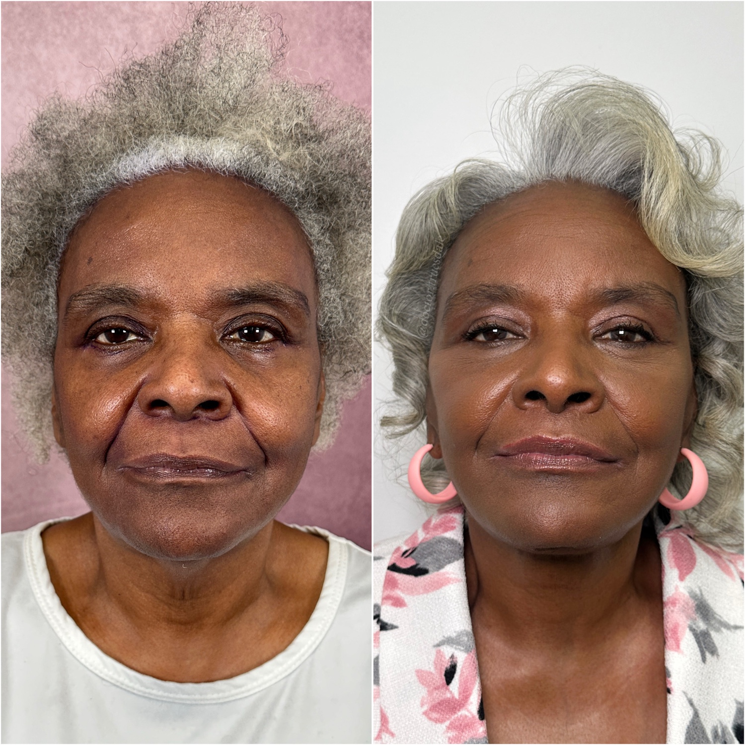 Before and after &mdash; lip lift as part of The Masterpiece, frontal view