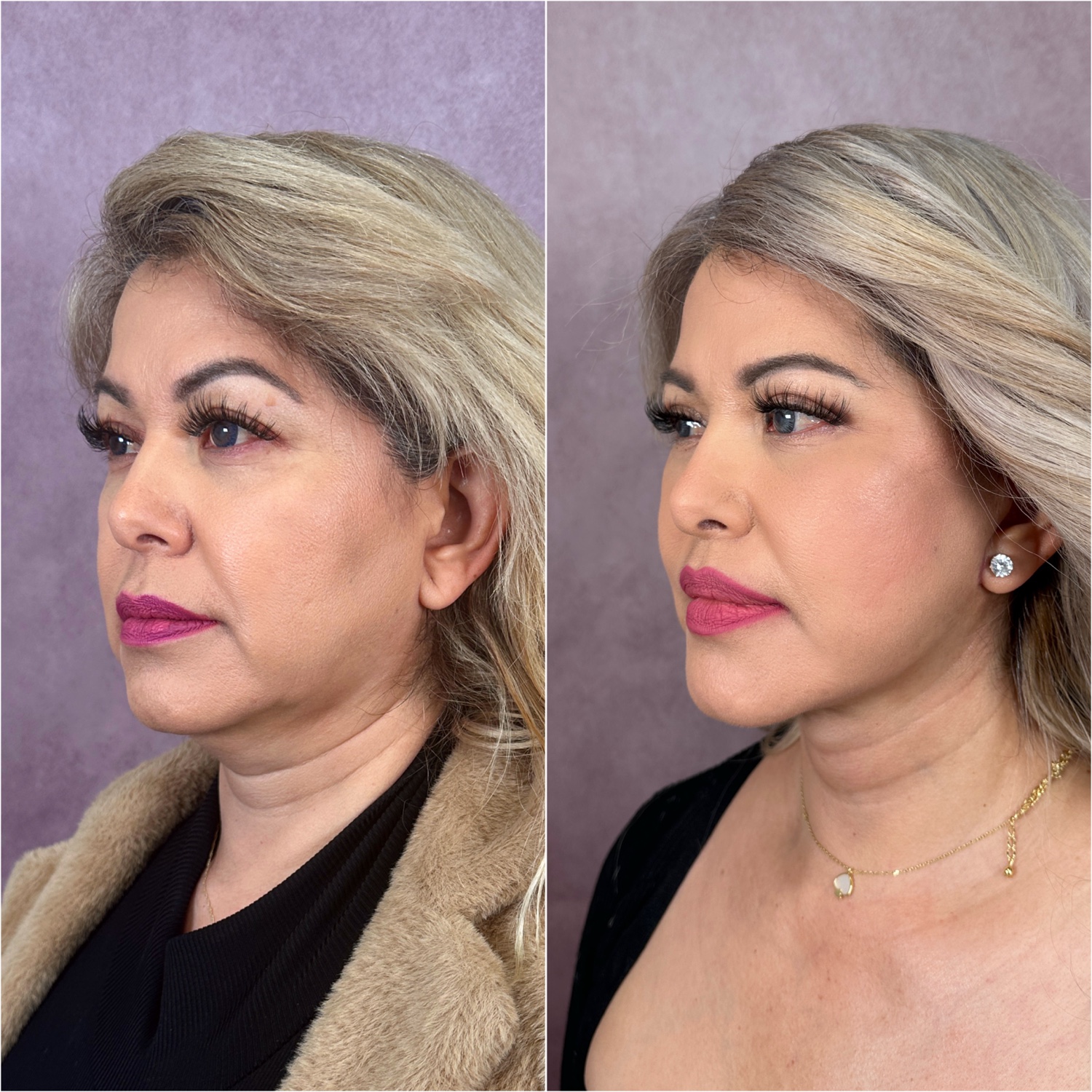 Before and after &mdash; lip lift as part of The Masterpiece, profile view