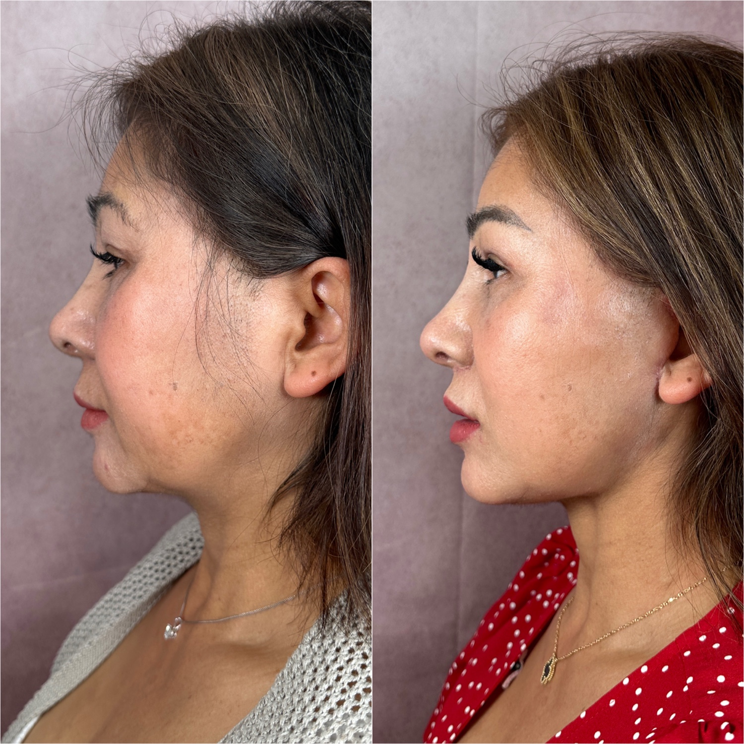 Before and after &mdash; lip lift as part of The Masterpiece, profile view
