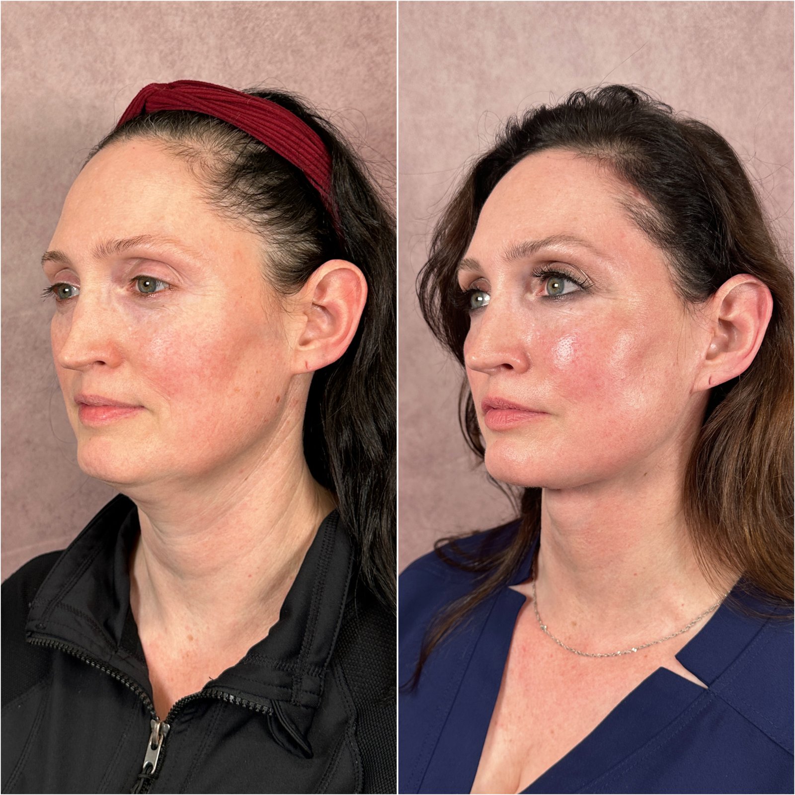 The Masterpiece Surgery&trade; patient &mdash; facelift, brow lift, and fat transfer before and after · before and after composite