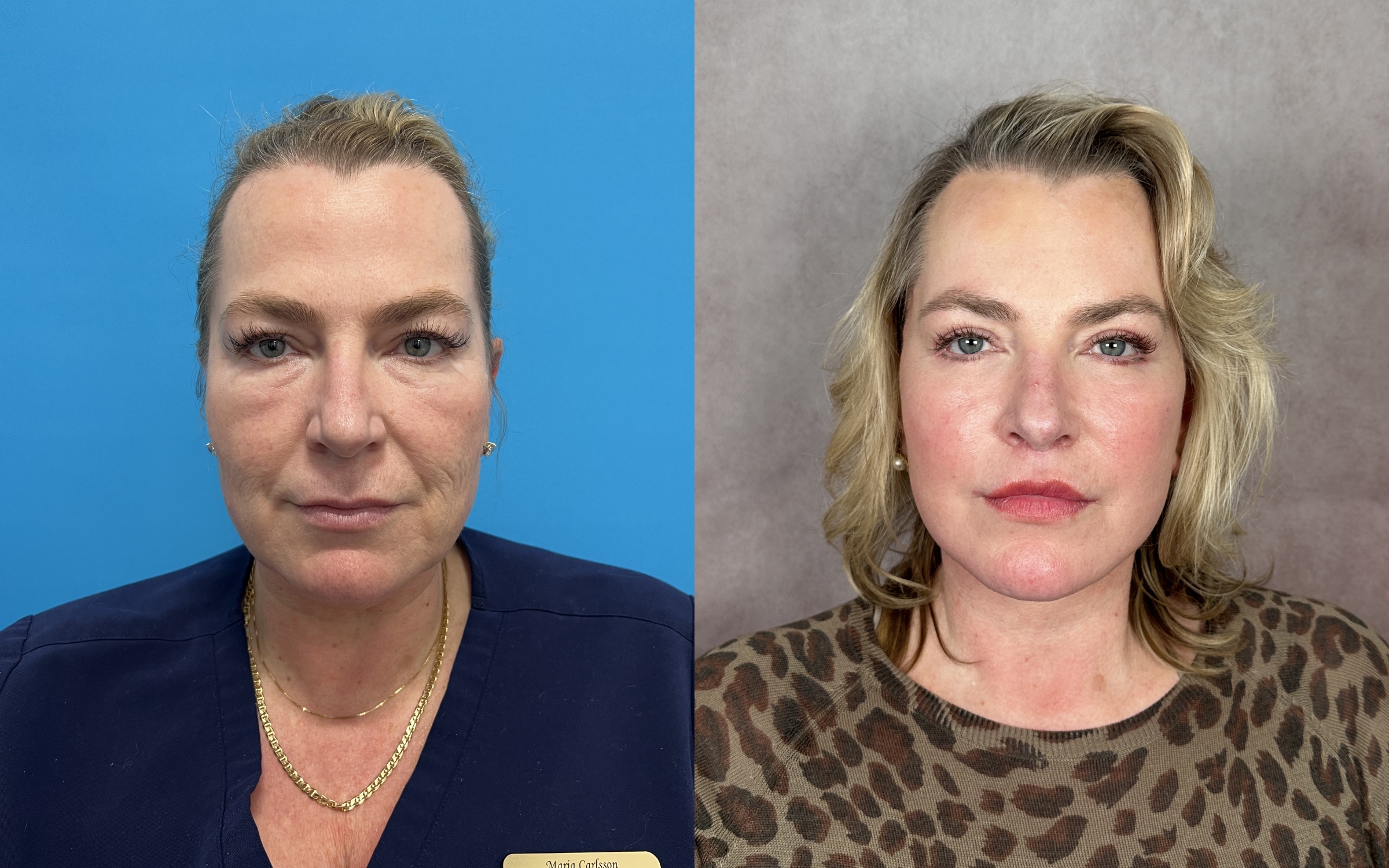 Before and after &mdash; The Masterpiece Surgery&trade;, frontal view