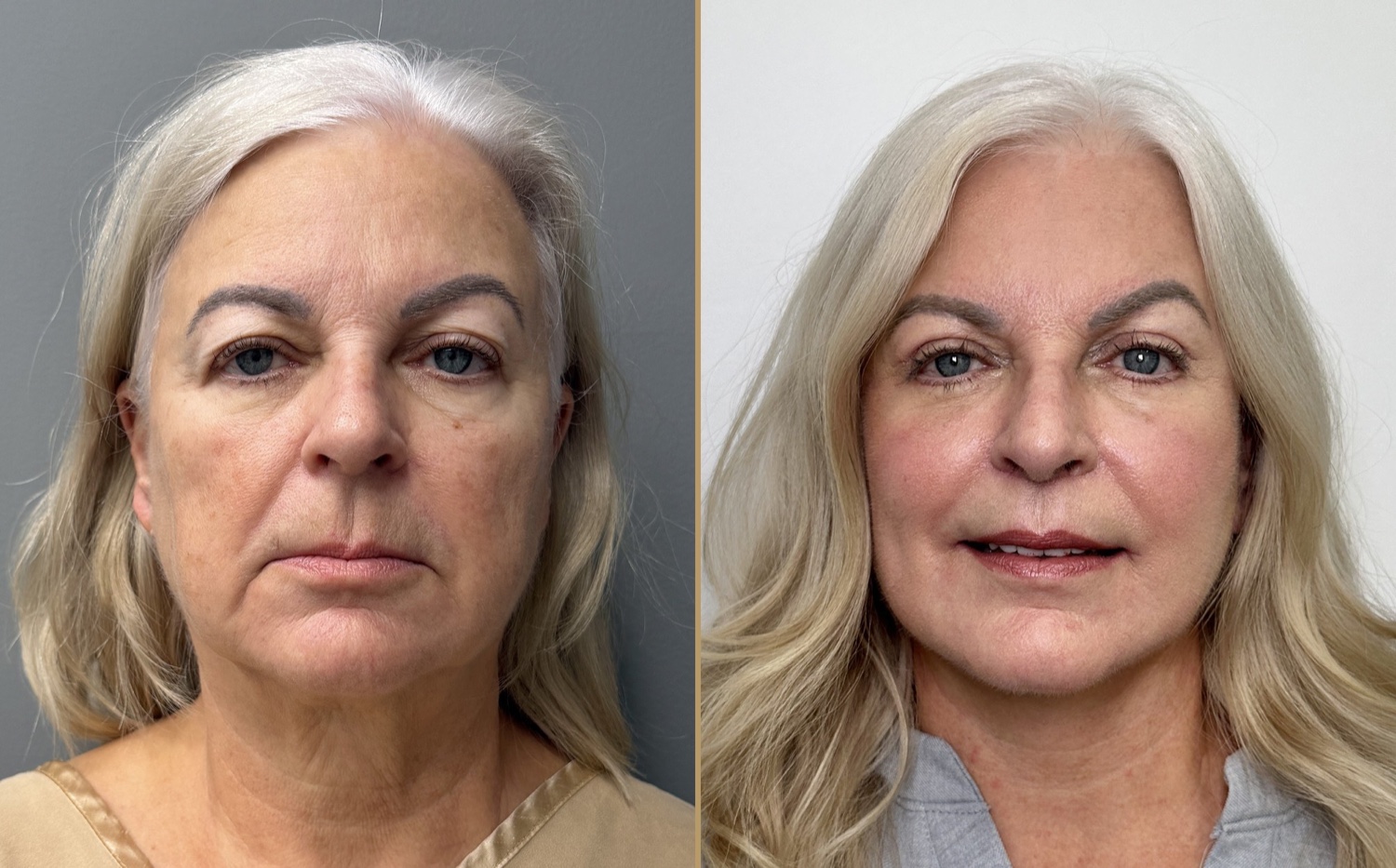 Before and after &mdash; The Masterpiece Surgery&trade;, frontal view