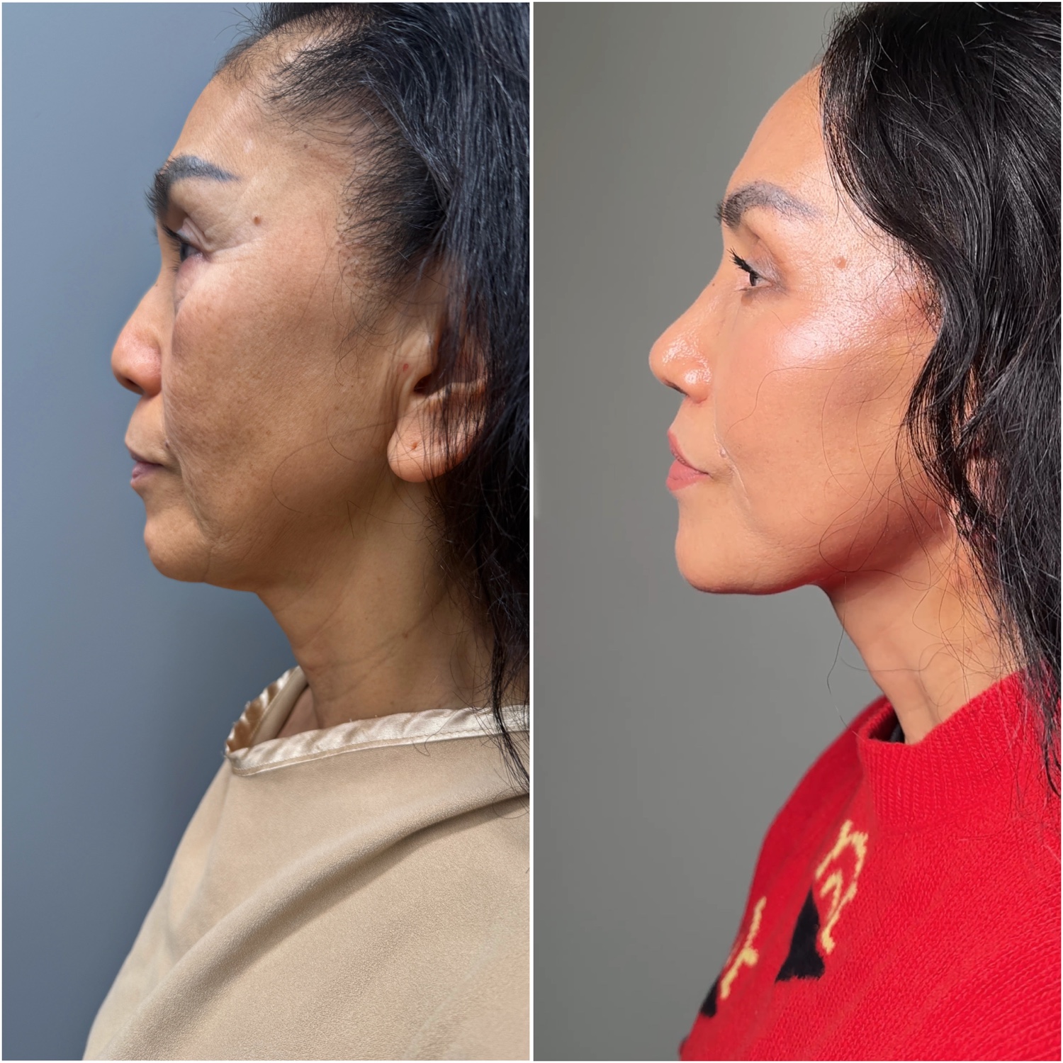Before and after &mdash; The Masterpiece Surgery&trade;, profile view
