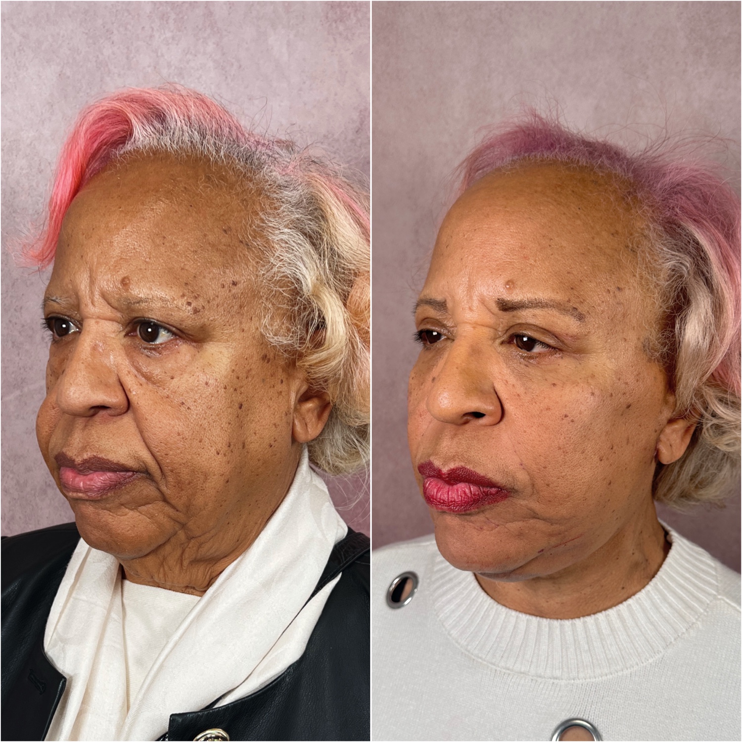 Before and after &mdash; The Masterpiece Surgery&trade;, oblique view