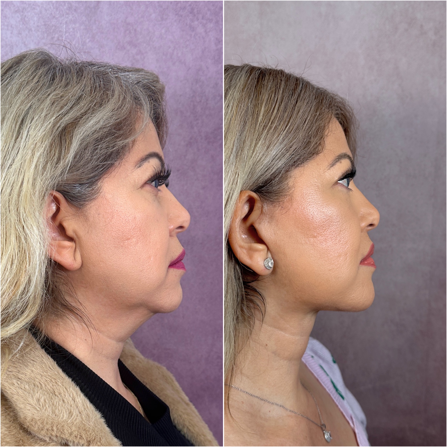 Before and after &mdash; The Masterpiece Surgery&trade;, profile view