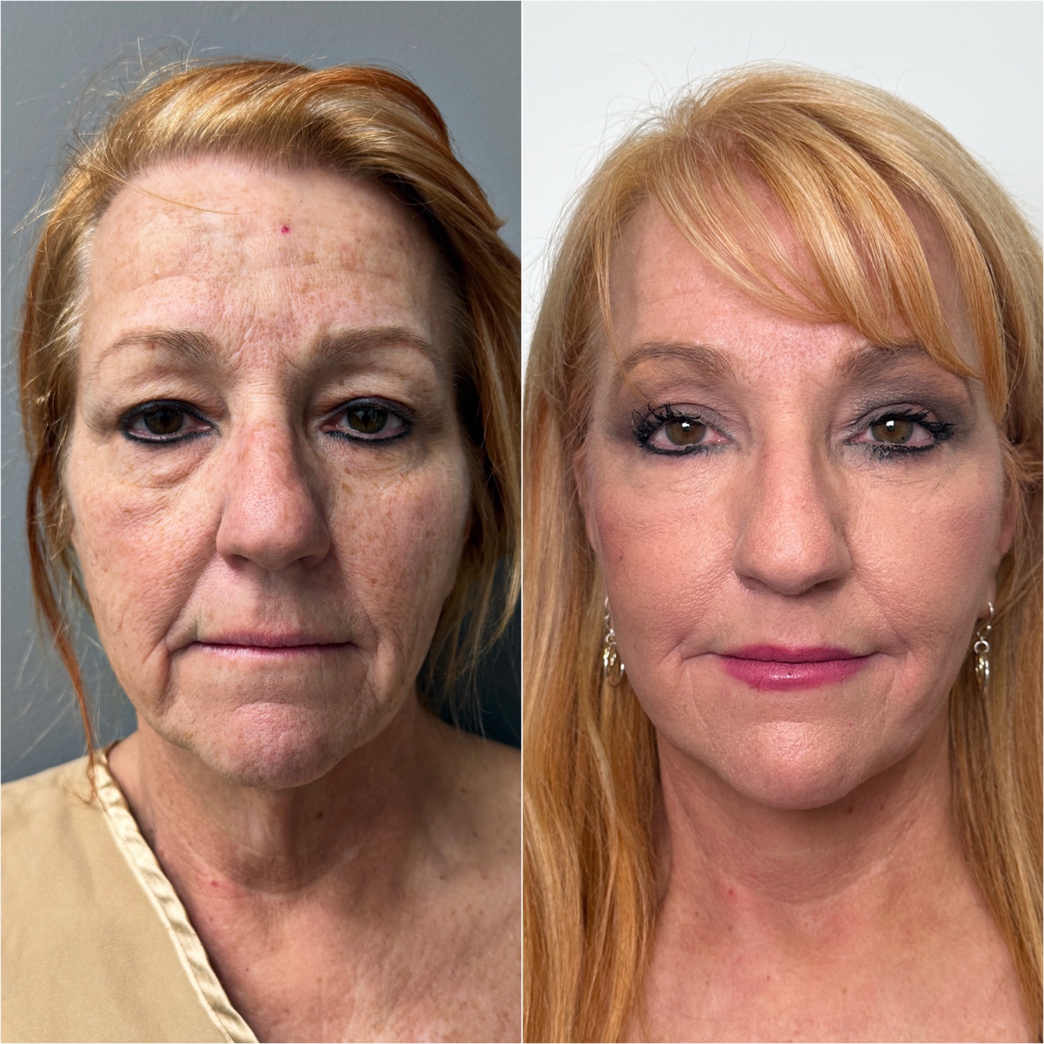 Before and after &mdash; The Masterpiece Surgery&trade;, frontal view