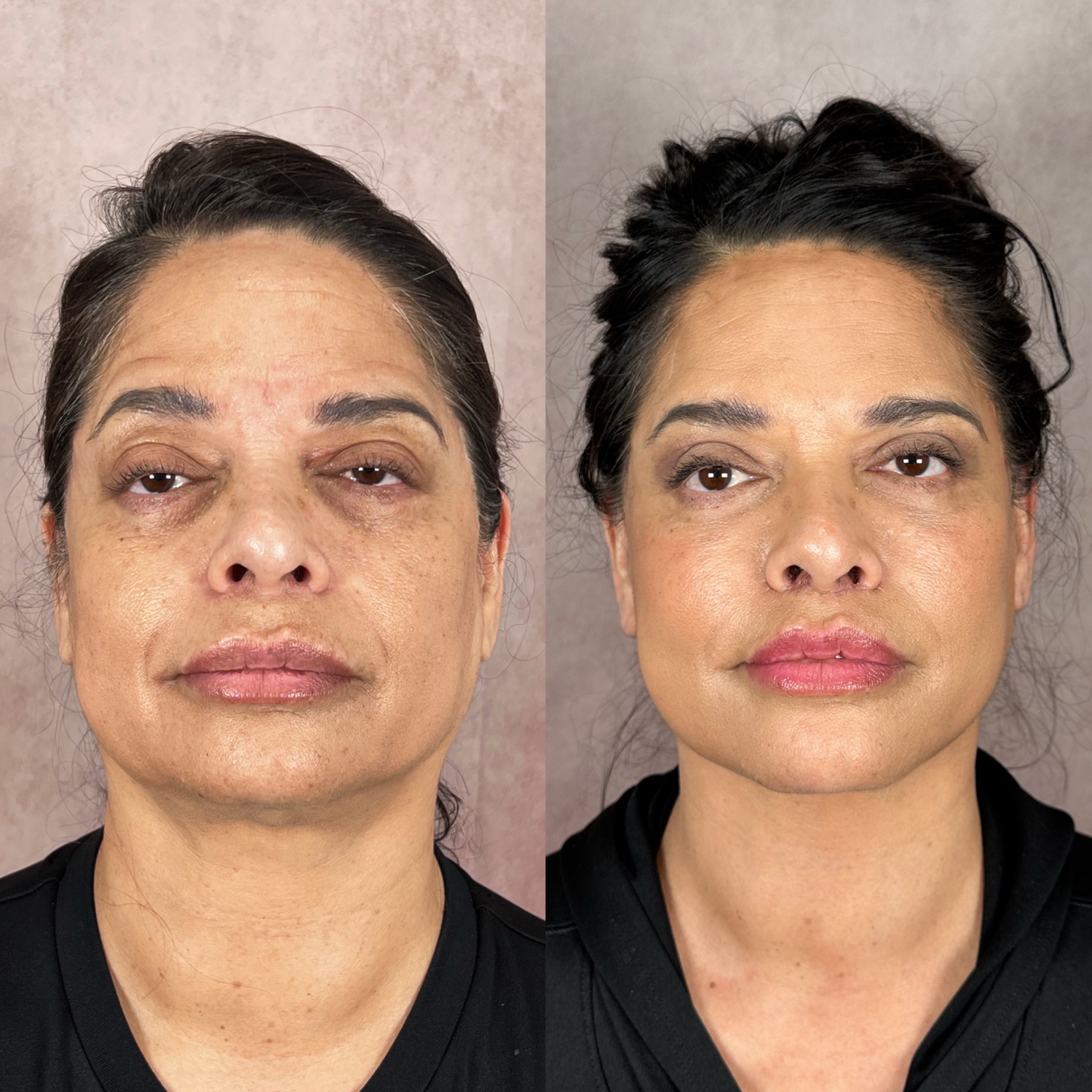 Before and after &mdash; The Masterpiece Surgery&trade; · before and after composite