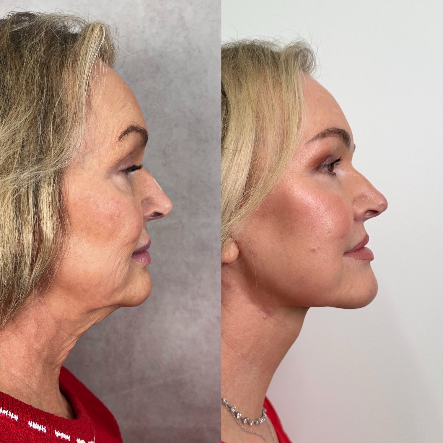 Before and after &mdash; The Masterpiece Surgery&trade;, profile view
