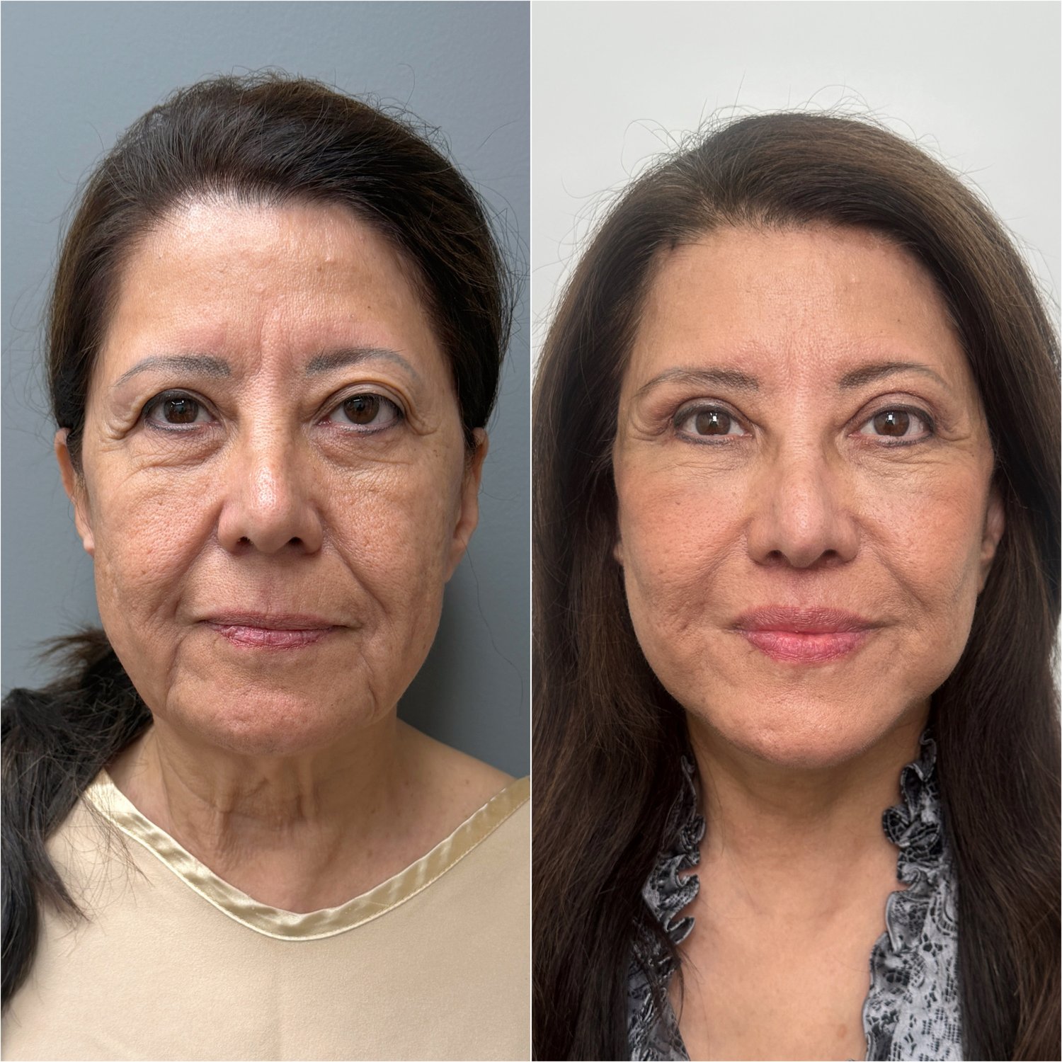 Deep Plane Facelift & Neck Lift before and after · frontal view