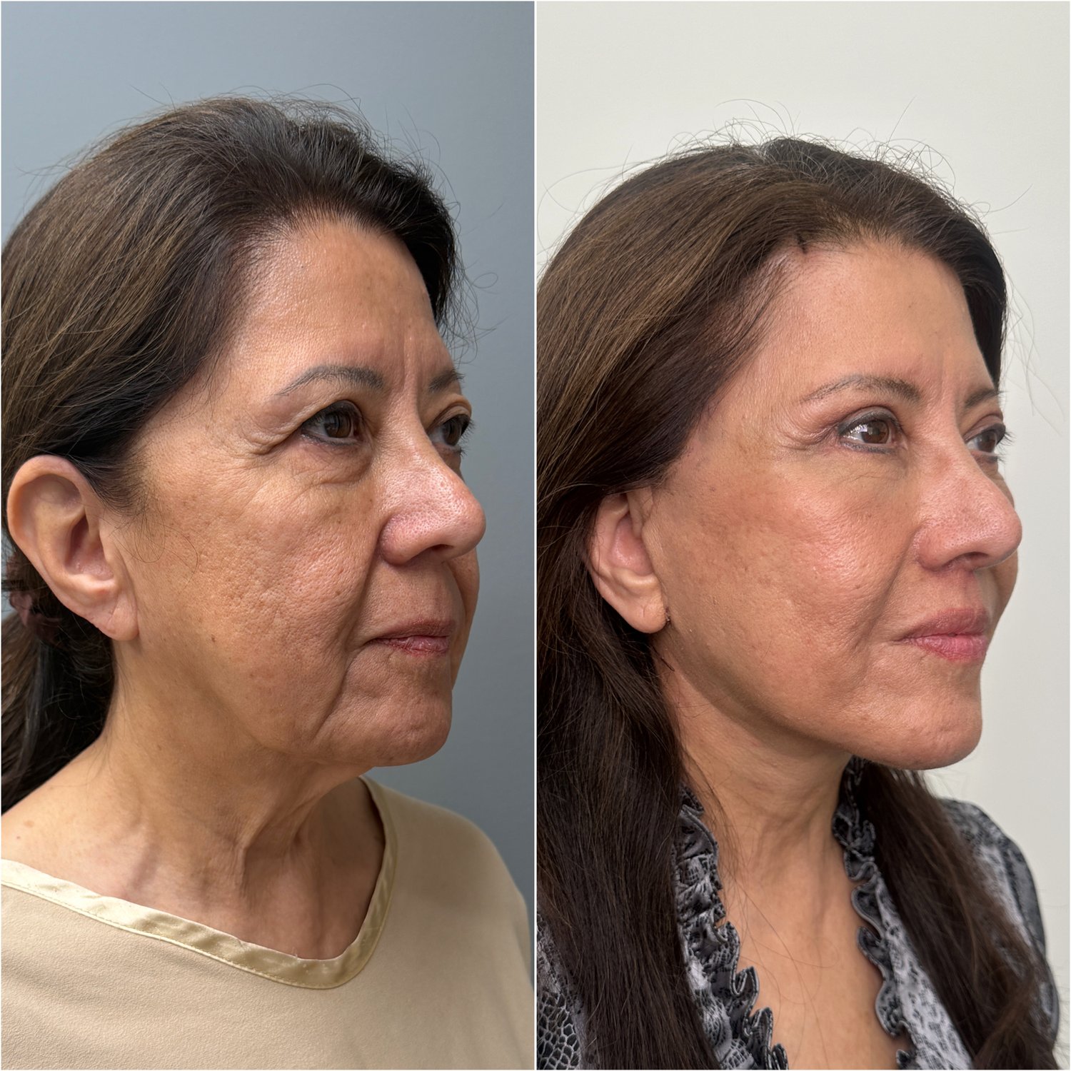 Before and after &mdash; The Masterpiece Surgery&trade;, oblique view