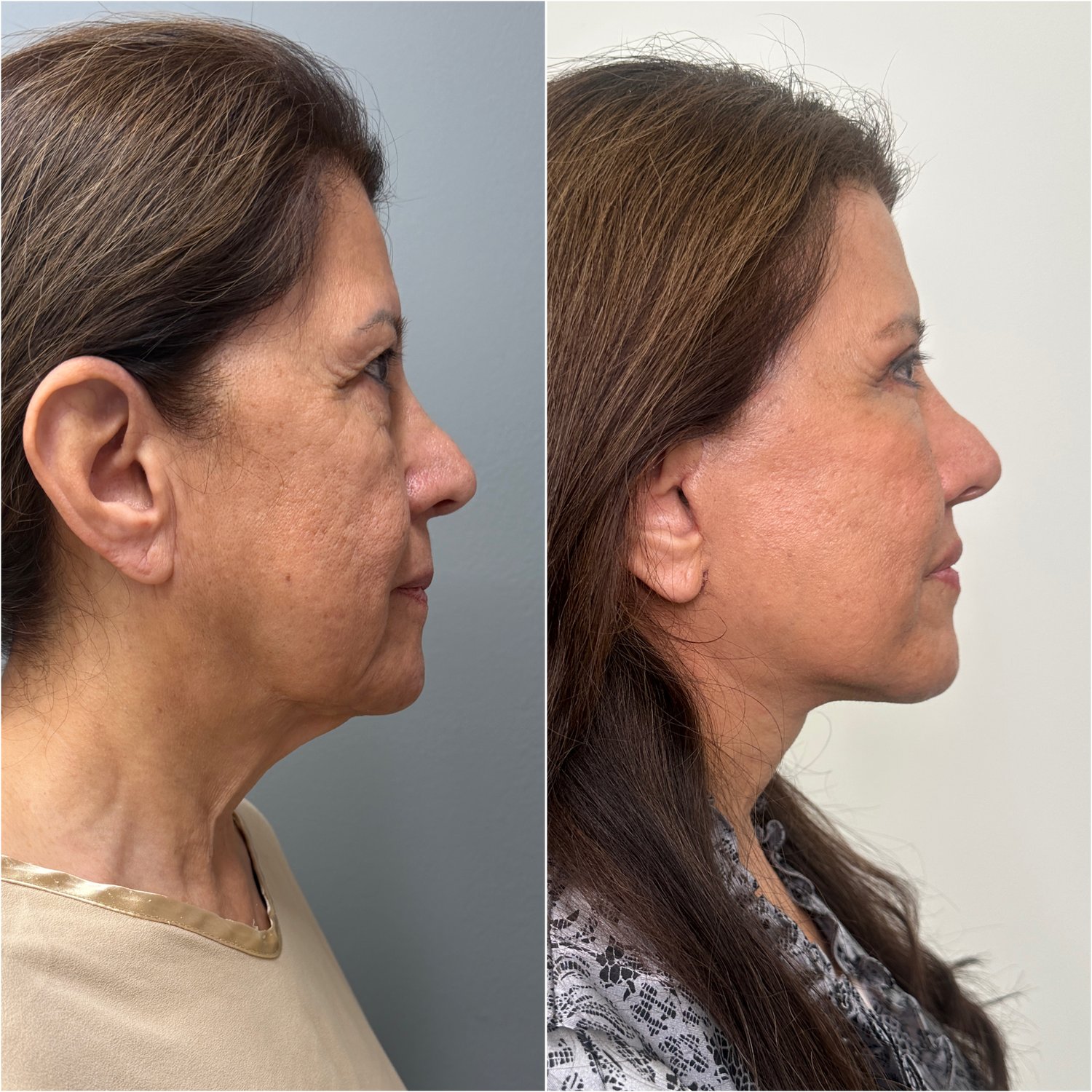 Before and after &mdash; The Masterpiece Surgery&trade;, profile view